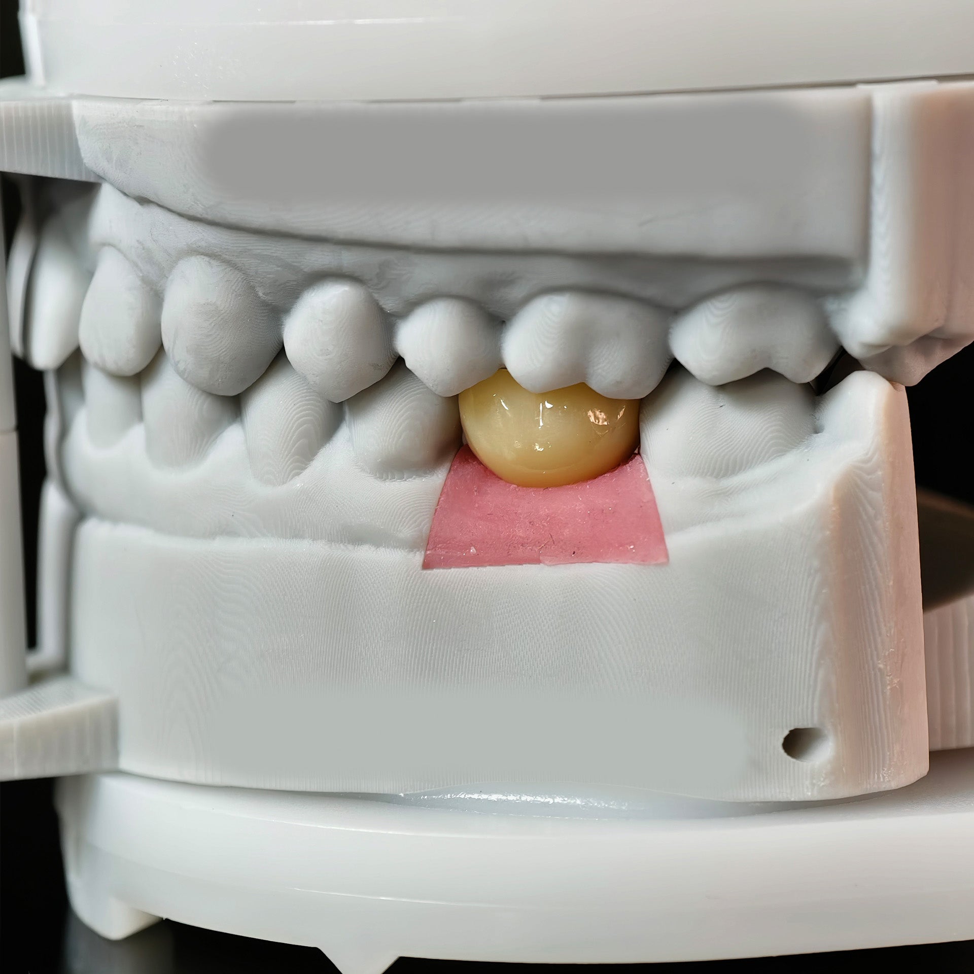 Zirconia Implant Crown With Gold Plating