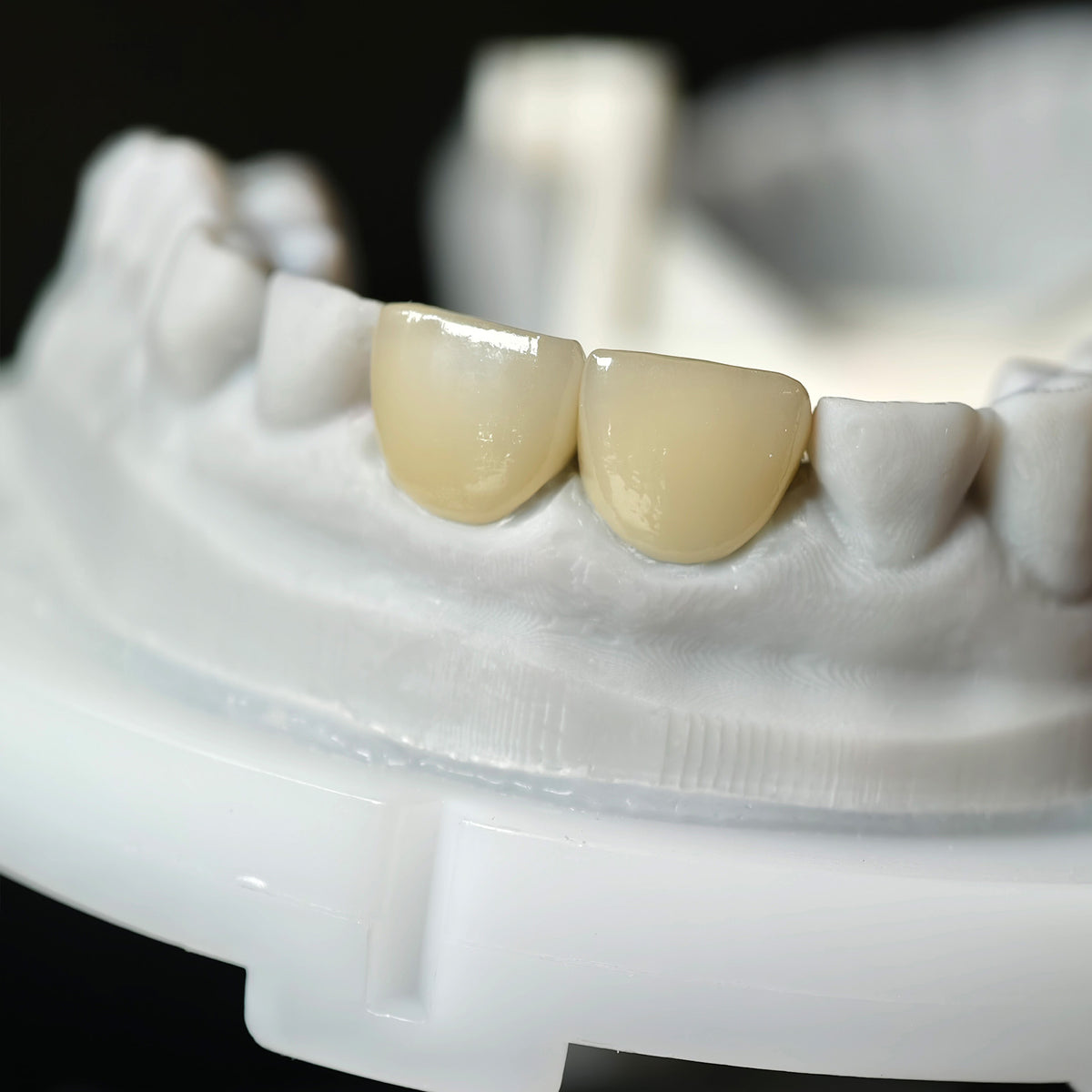 Zirconia Veneer. High Transparency/Translucent, Natural Shade