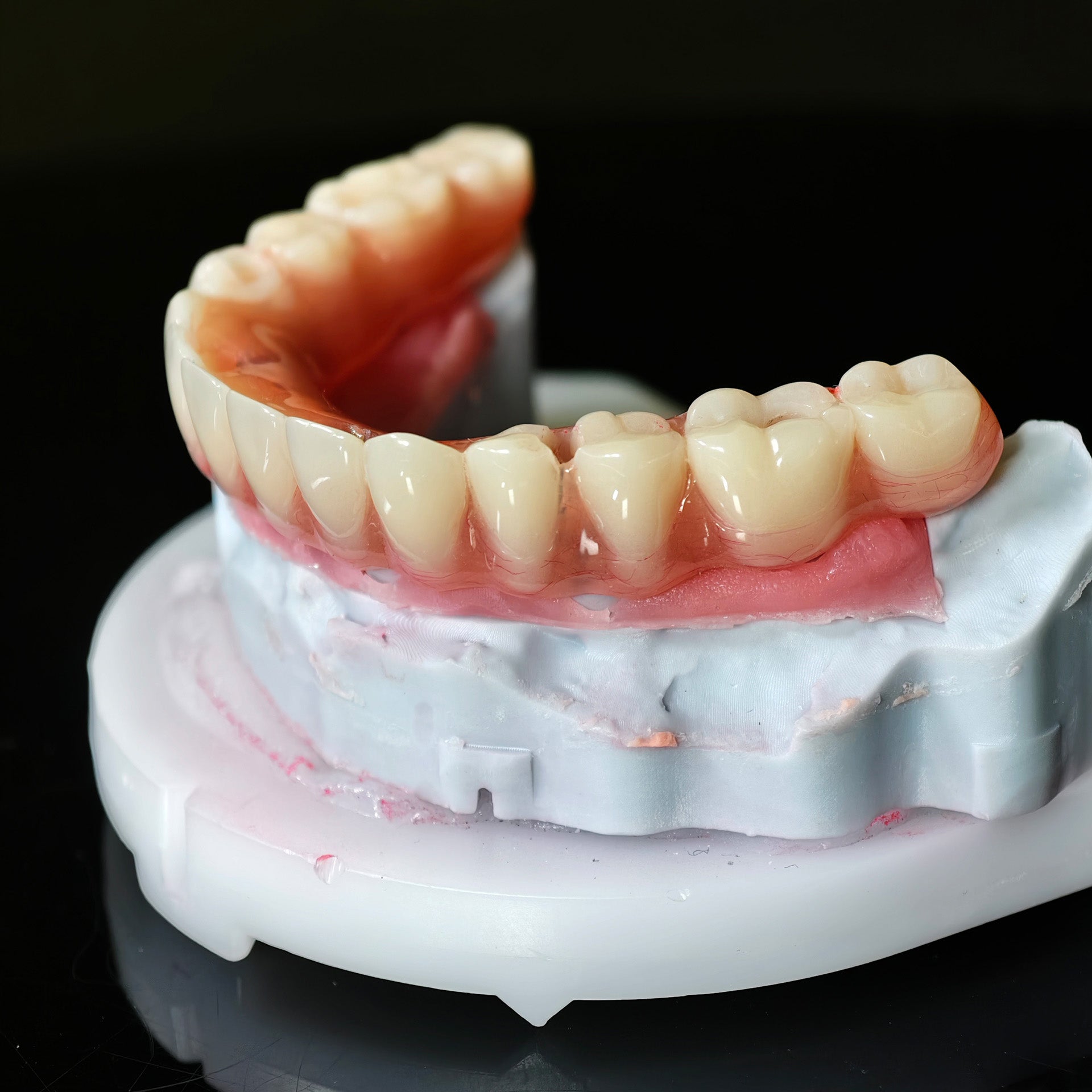 Acrylic Denture With Screw Retained