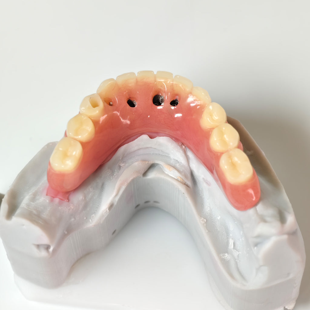 Acrylic Denture With Ti-Bar And Screw Retained
