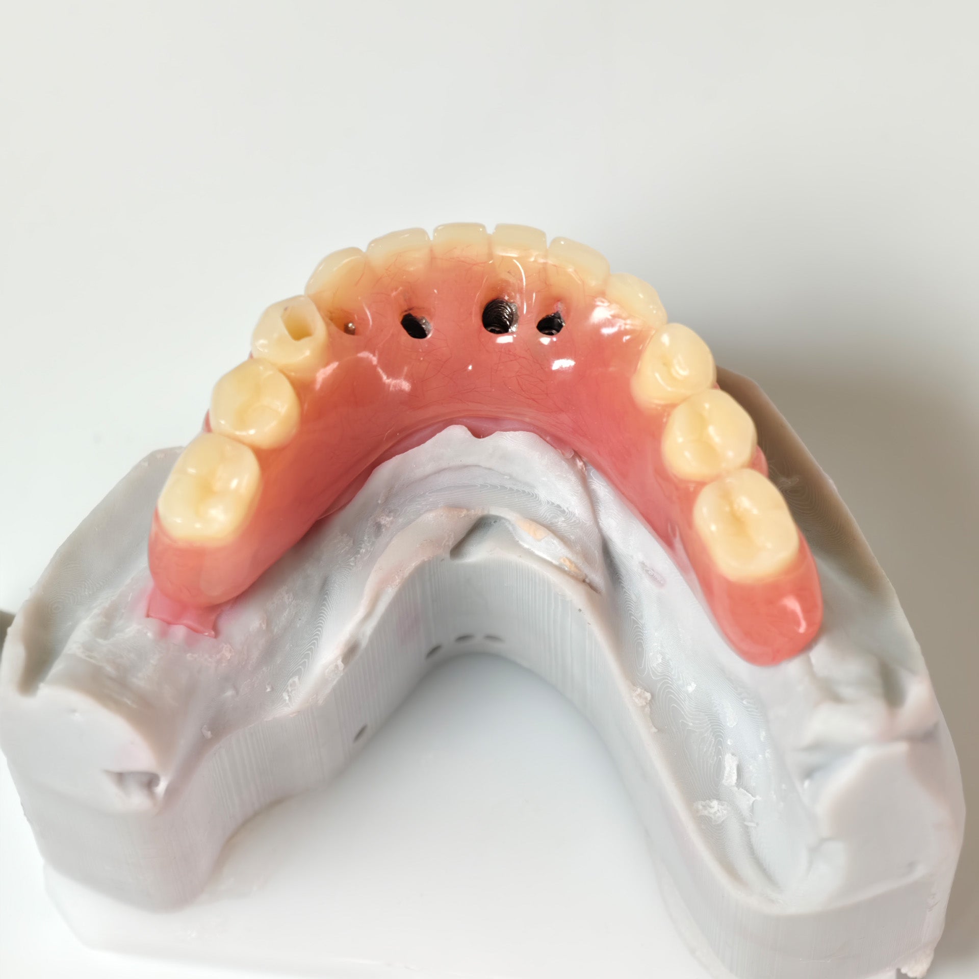 Acrylic Denture With Ti-Bar And Screw Retained