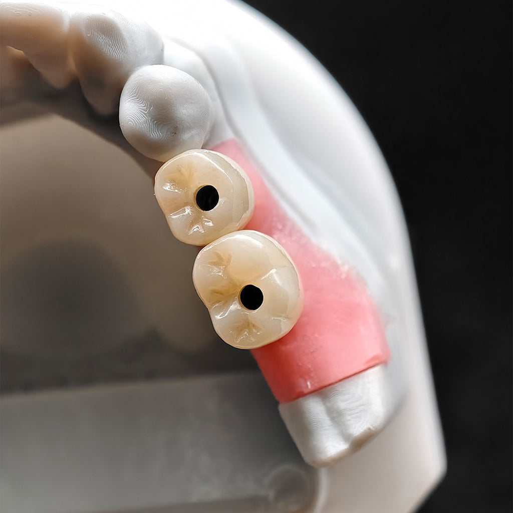 Custom Zirconia Implant Crowns