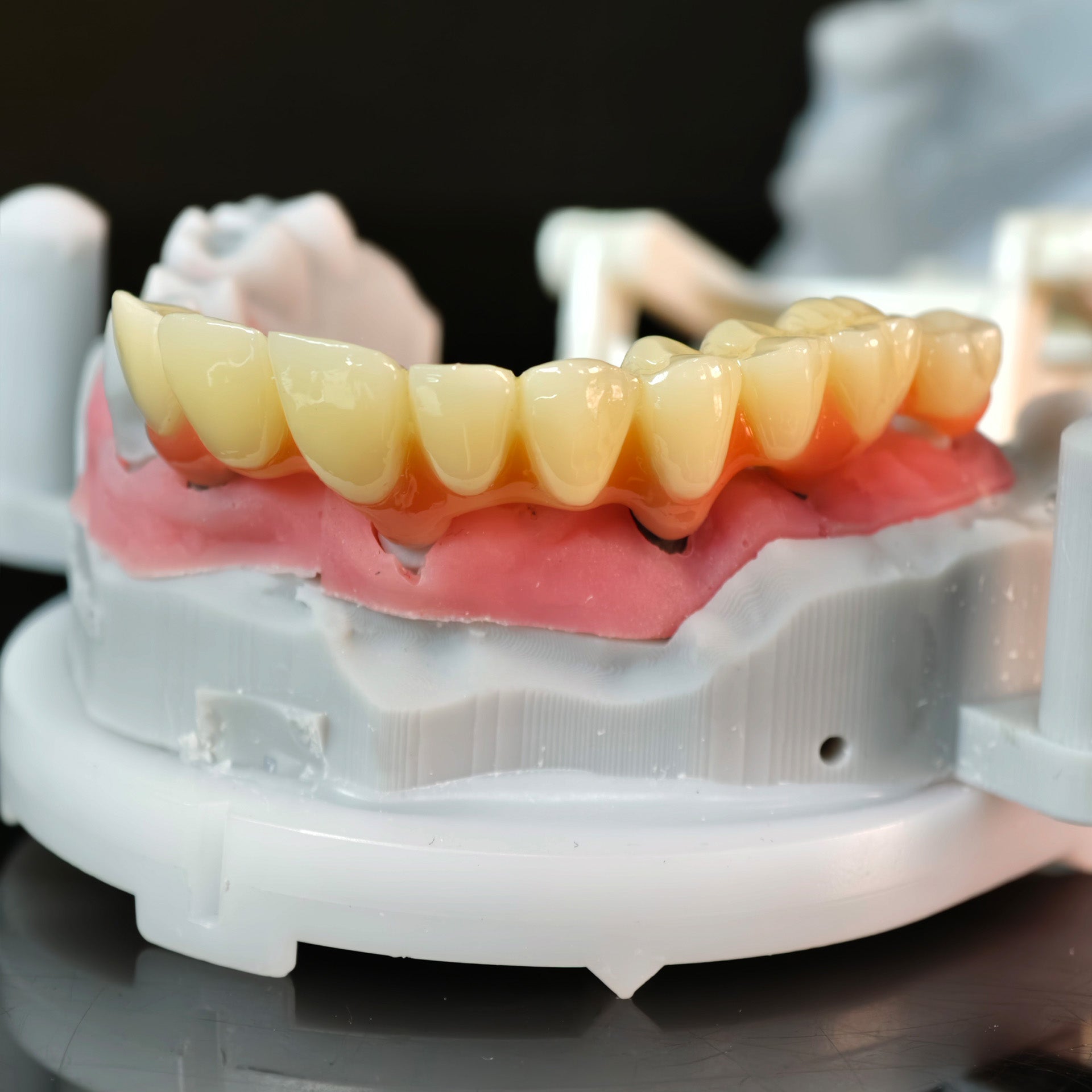 Custom Abutment And PMMA Bridge And Crown With Cement Retained