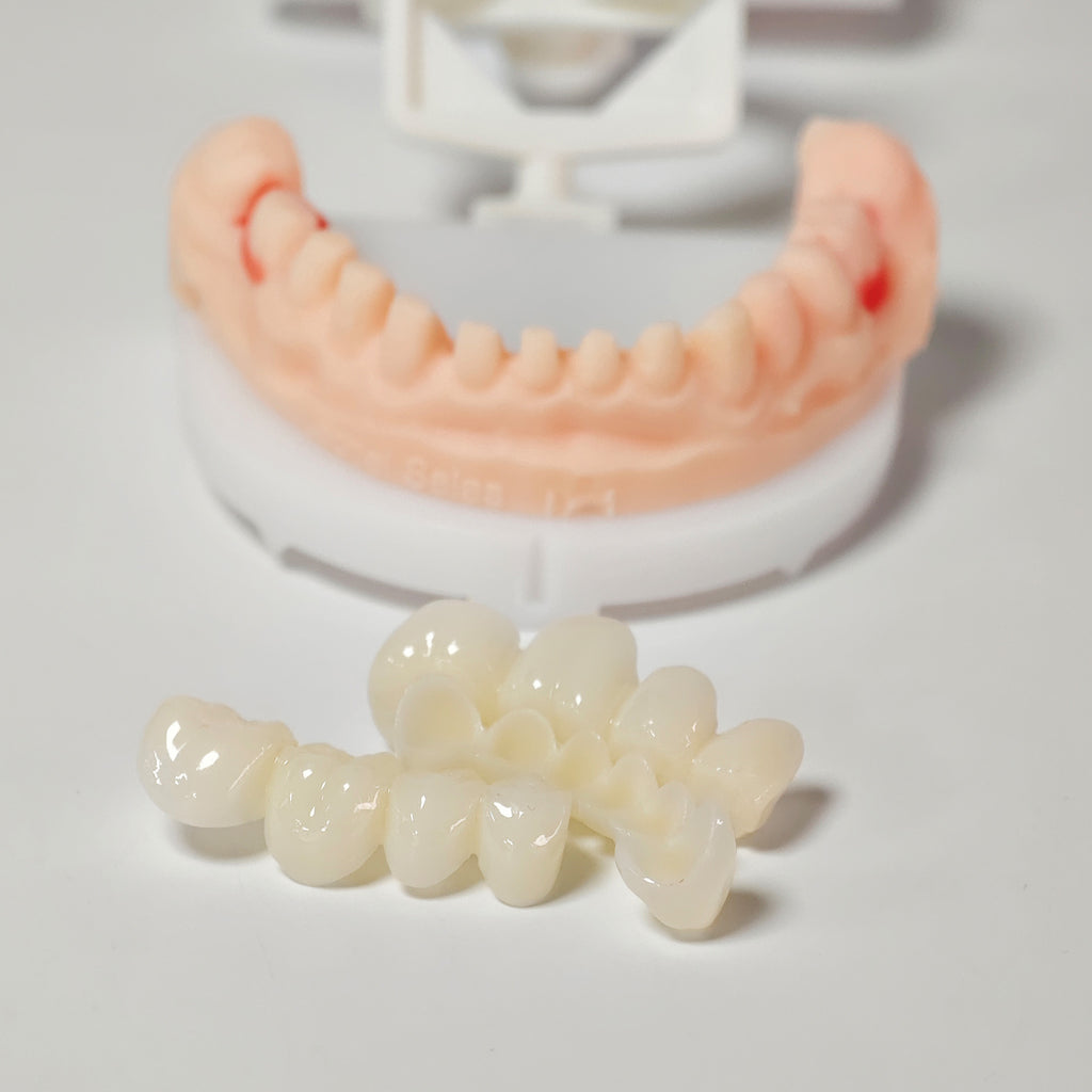 Full-Mouth Segmented PMMA Bridge With Cement Retained