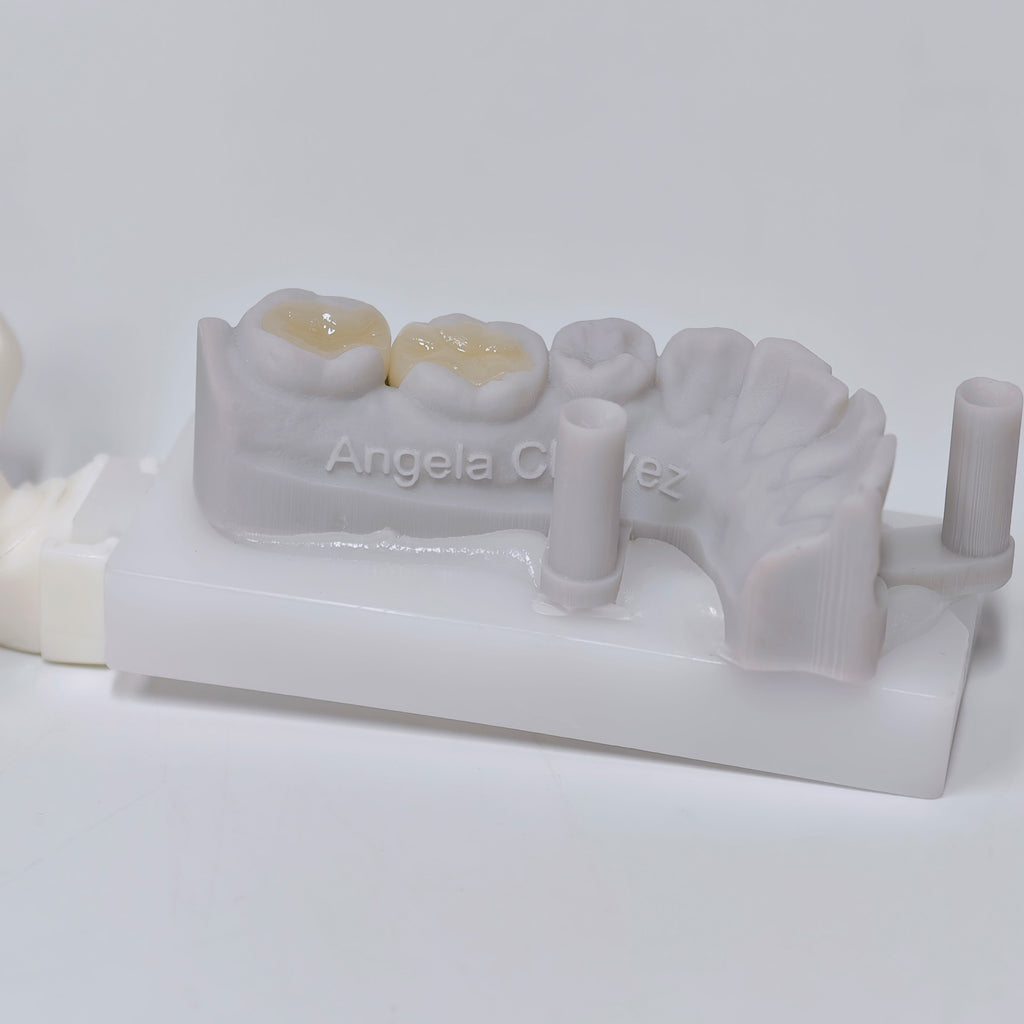 Full-Zirconia Laying With Cement-Retained