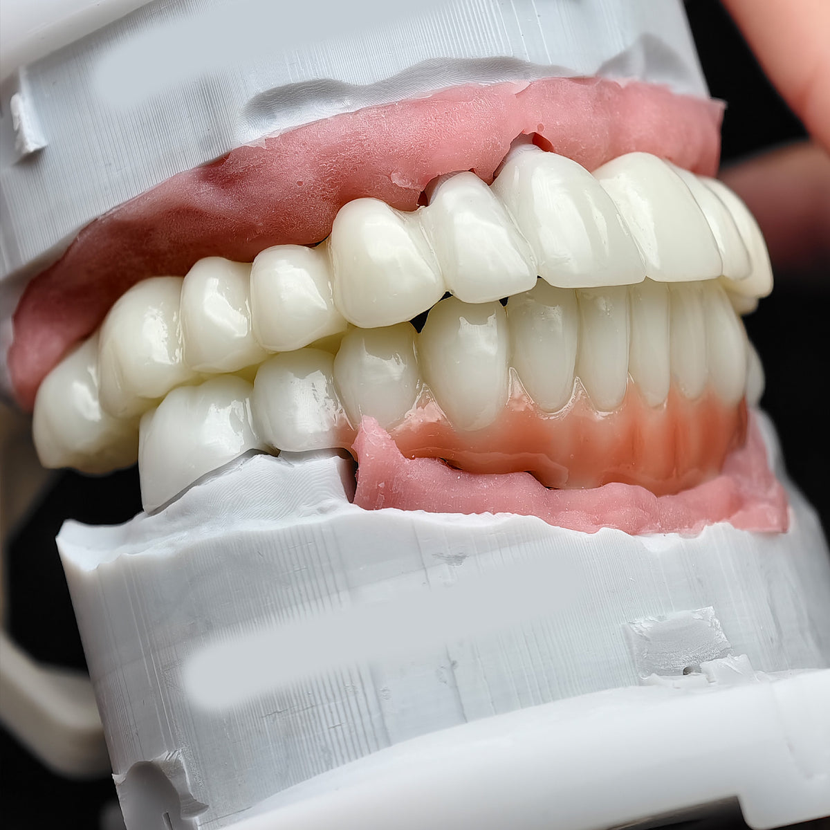 Pmma Bridge With Implant Seating Guide And Cemented
