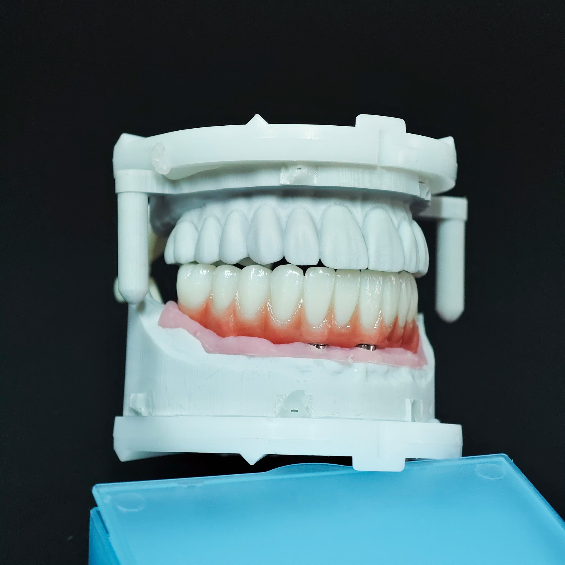 Zirconia Bridge With Ti-Base Abutment