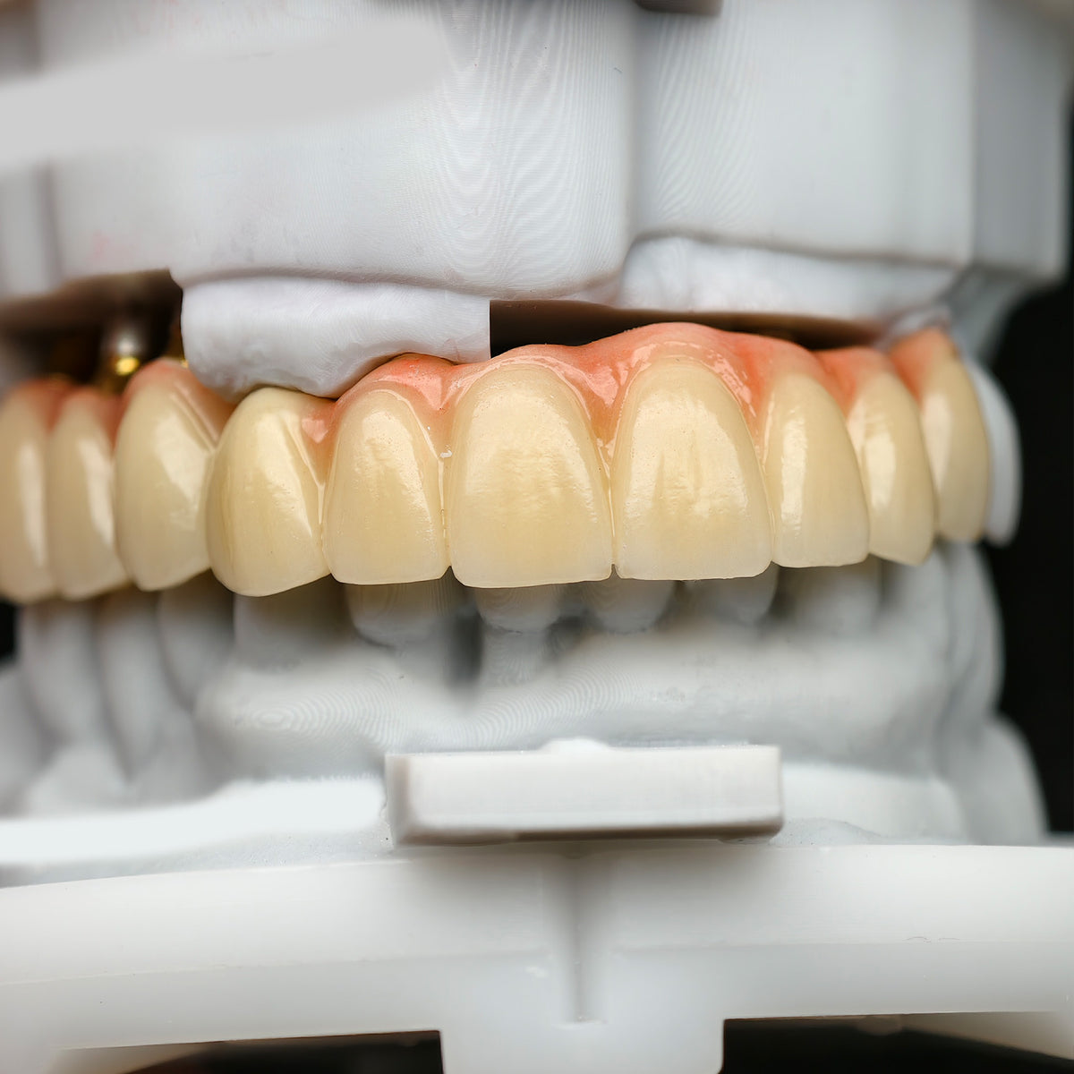 Zirconia Crown And Birdge With Cemented And Implant Seating Guide