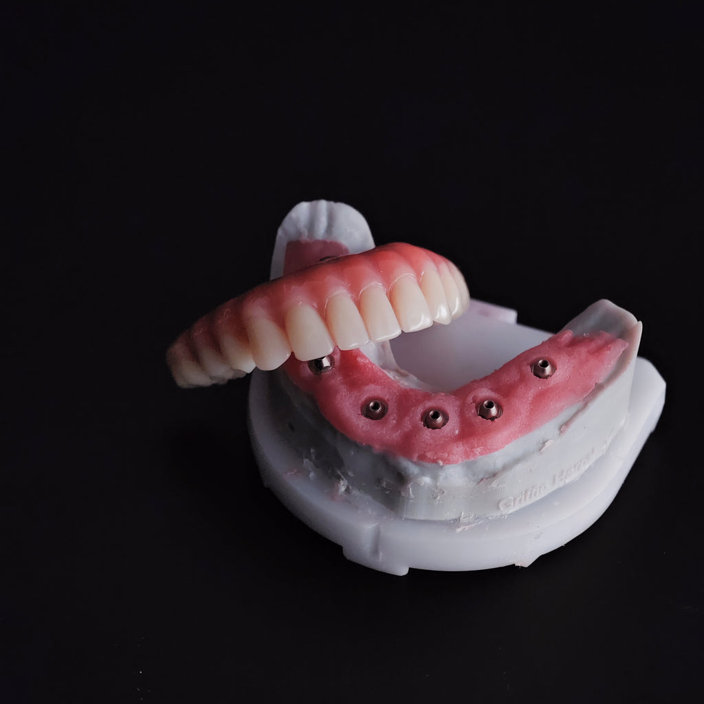 An Acrylic Denture With A Titanium Bar (Ti-Bar) Cost-Effective Full Arch Restoration Screw Retained