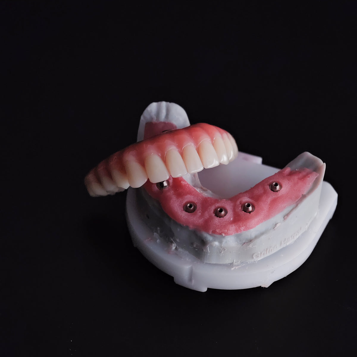An Acrylic Denture With A Titanium Bar (Ti-Bar) Cost-Effective Full Arch Restoration Screw Retained