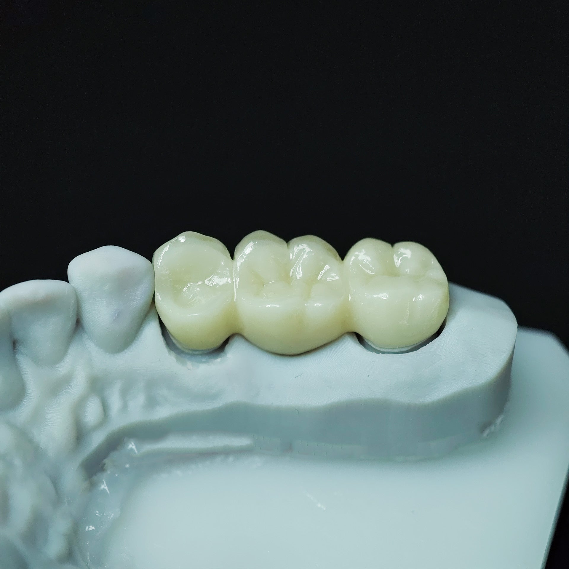 Beautiful Zirconia Bridge