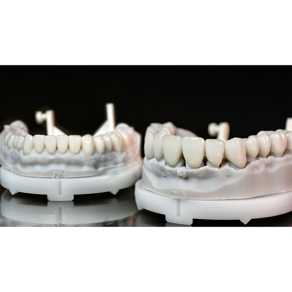 Ceramic Veneers And Crown With Cement Retained