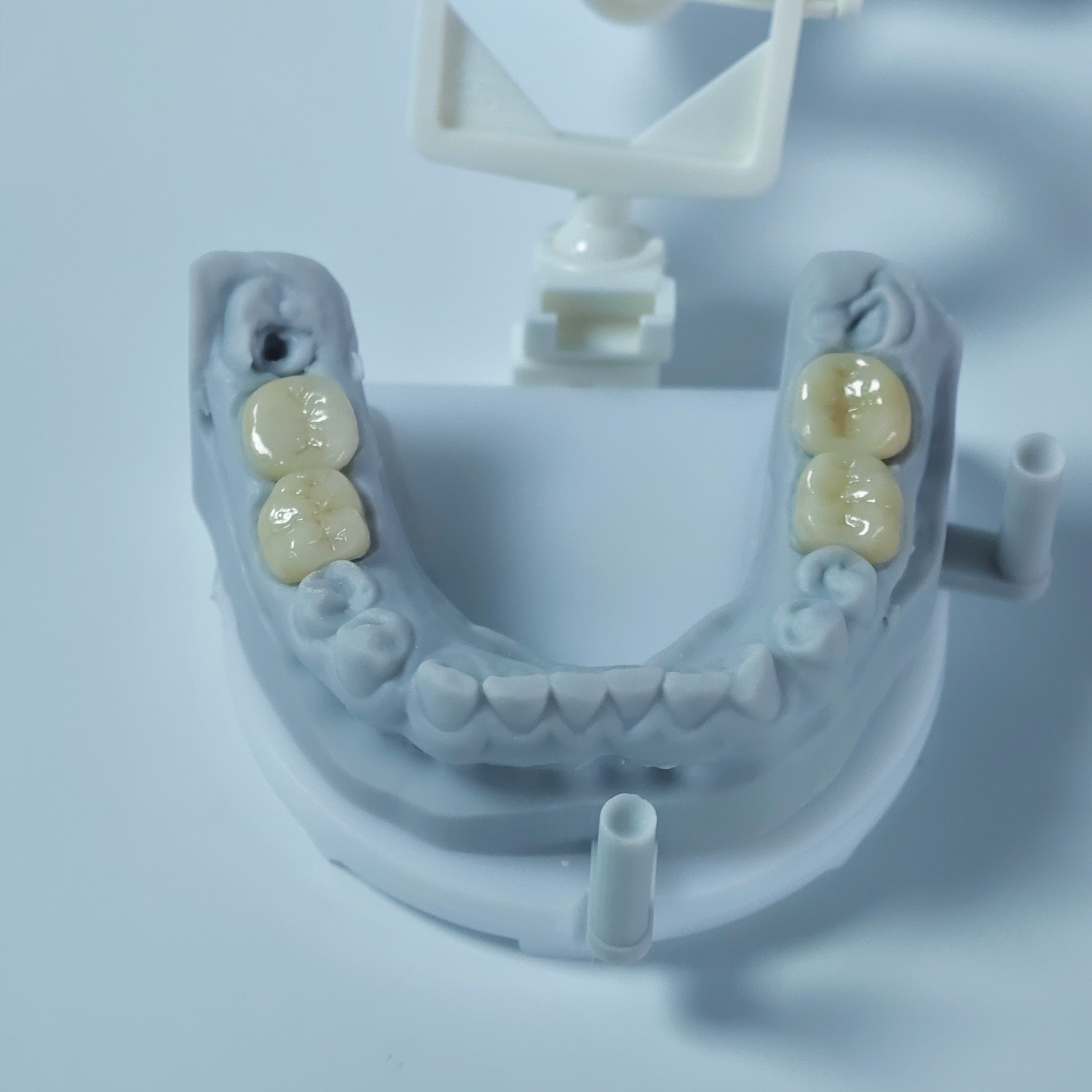 Co - Cr PFM Dental Crowns With Metal Post-And-Core