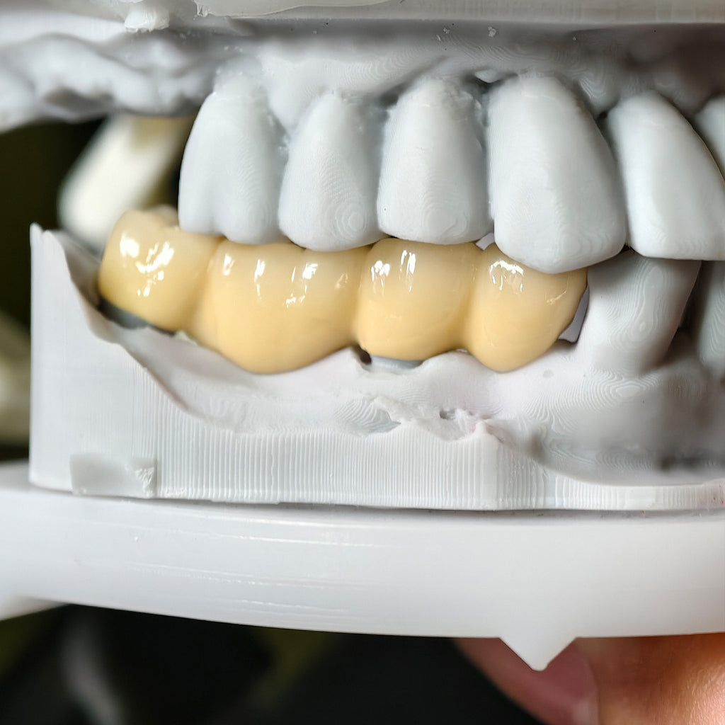 Co - Cr PFM Dental Bridge