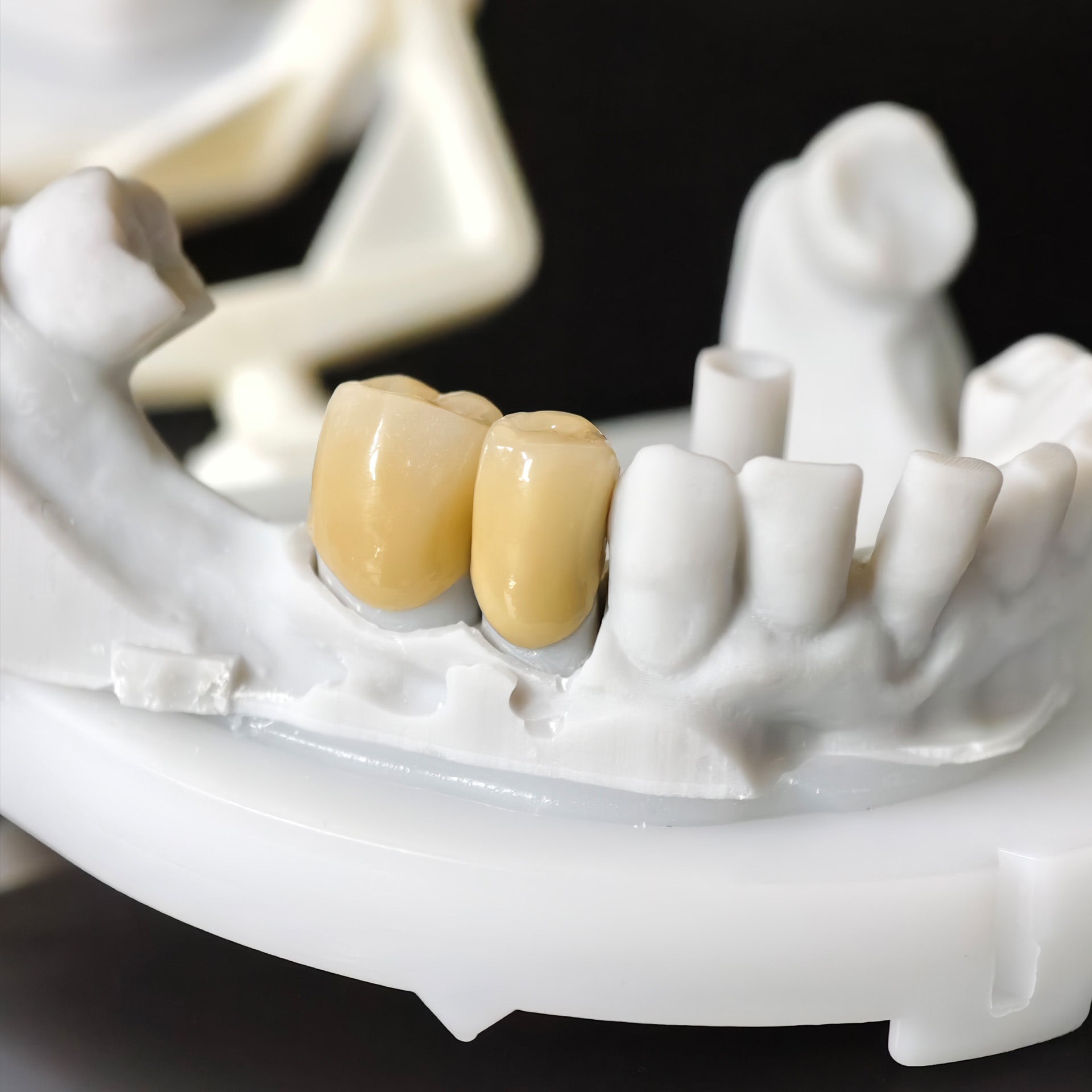 Co - Cr PFM Dental Bridge With Metal Post-And-Core