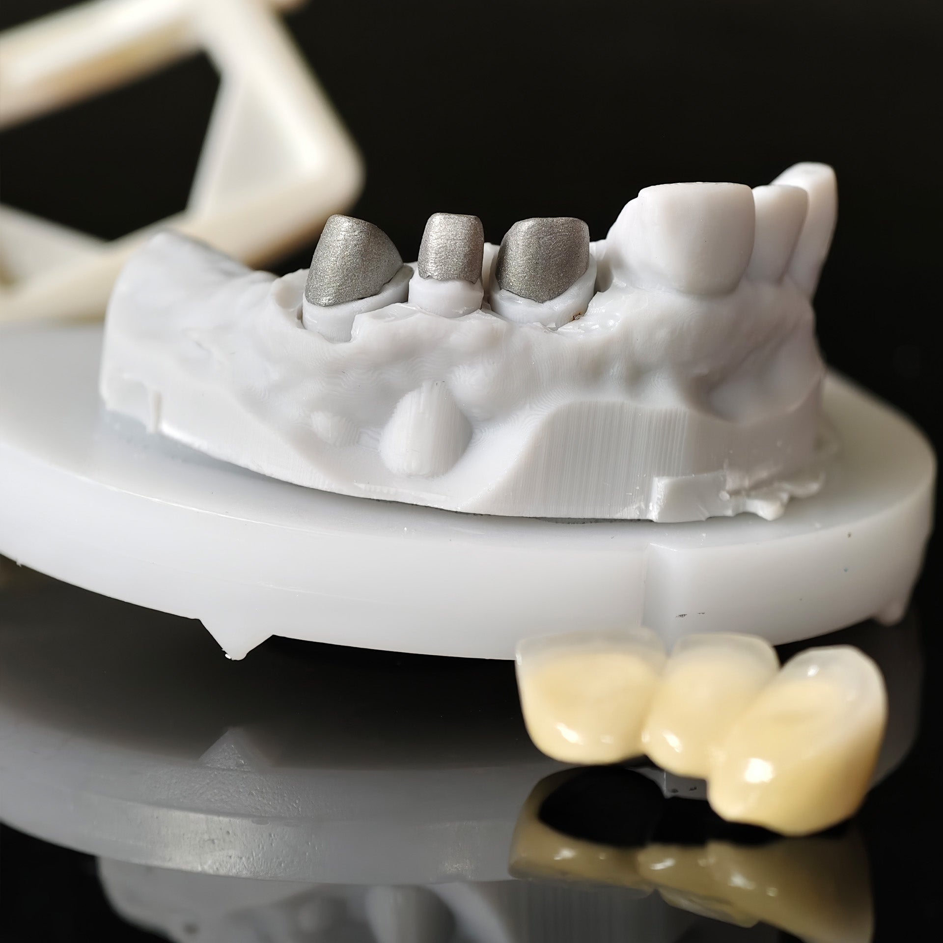 Co - Cr PFM Dental Bridge With Metal Post-And-Core