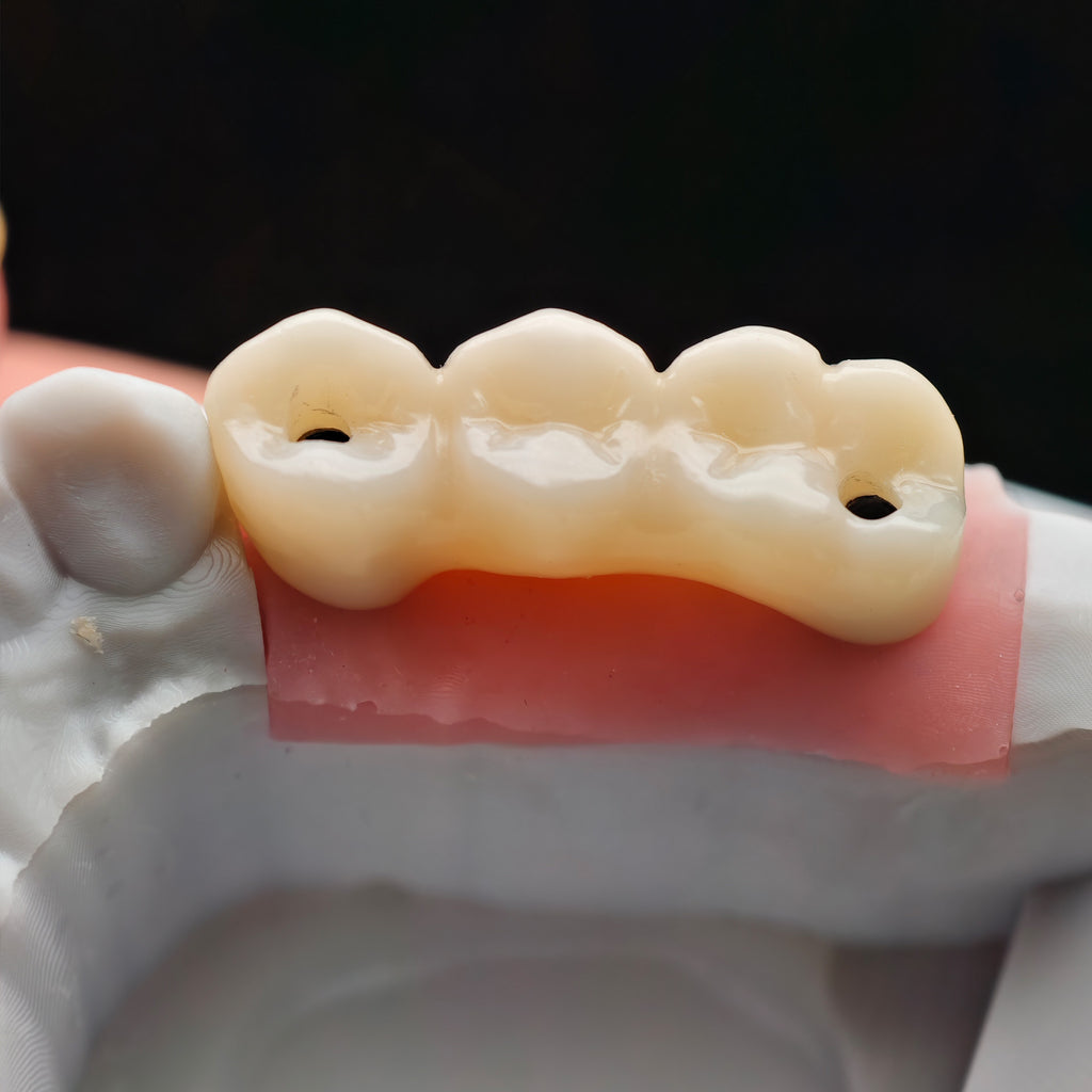 Custom Zirconia Implant Bridge