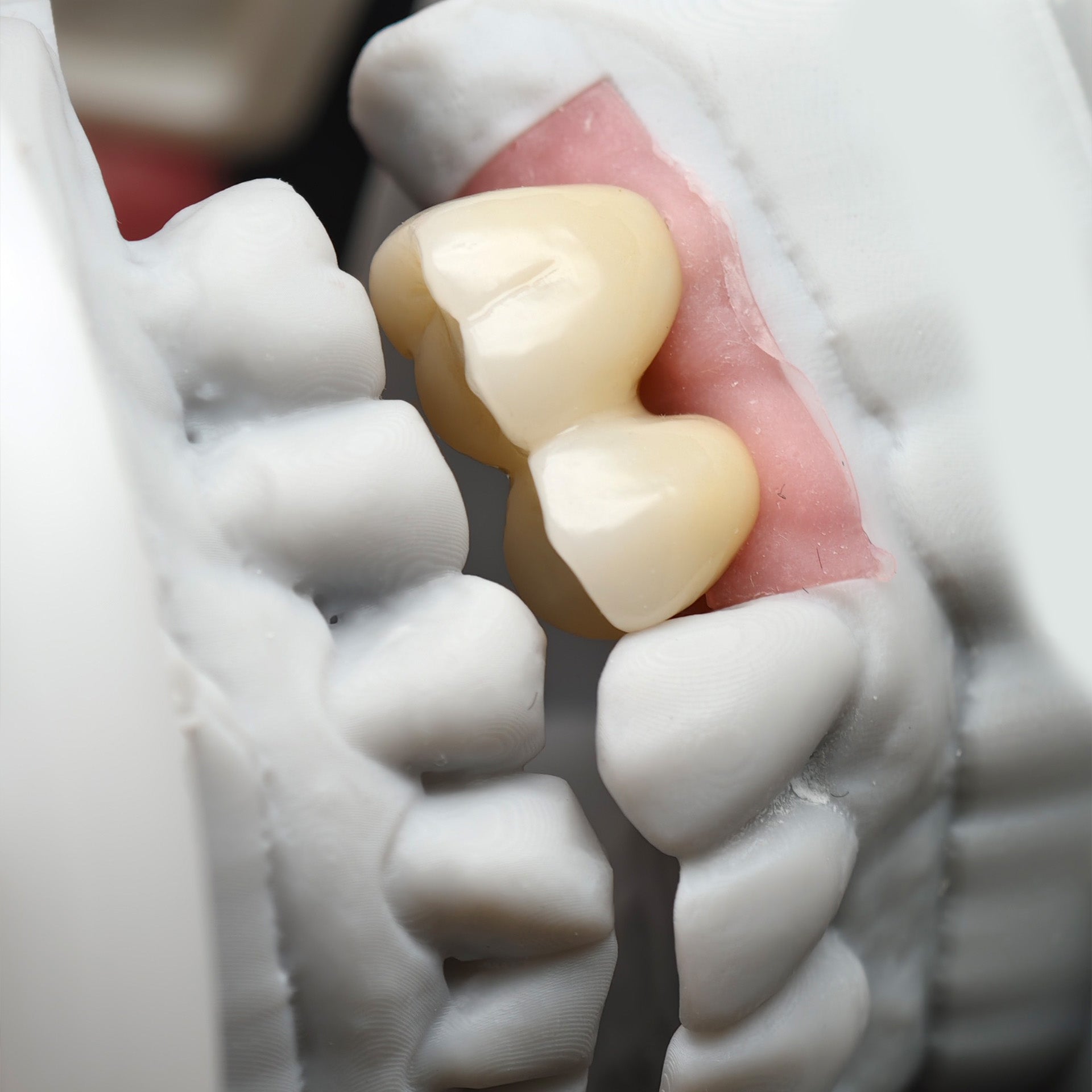 Custom Zirconia Implant Bridge