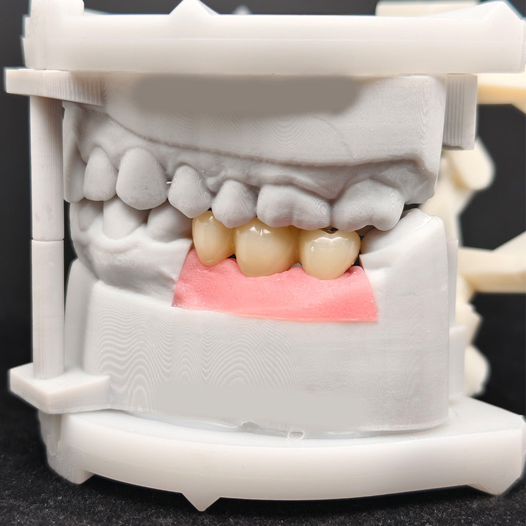 Custom Zirconia Implant Bridge