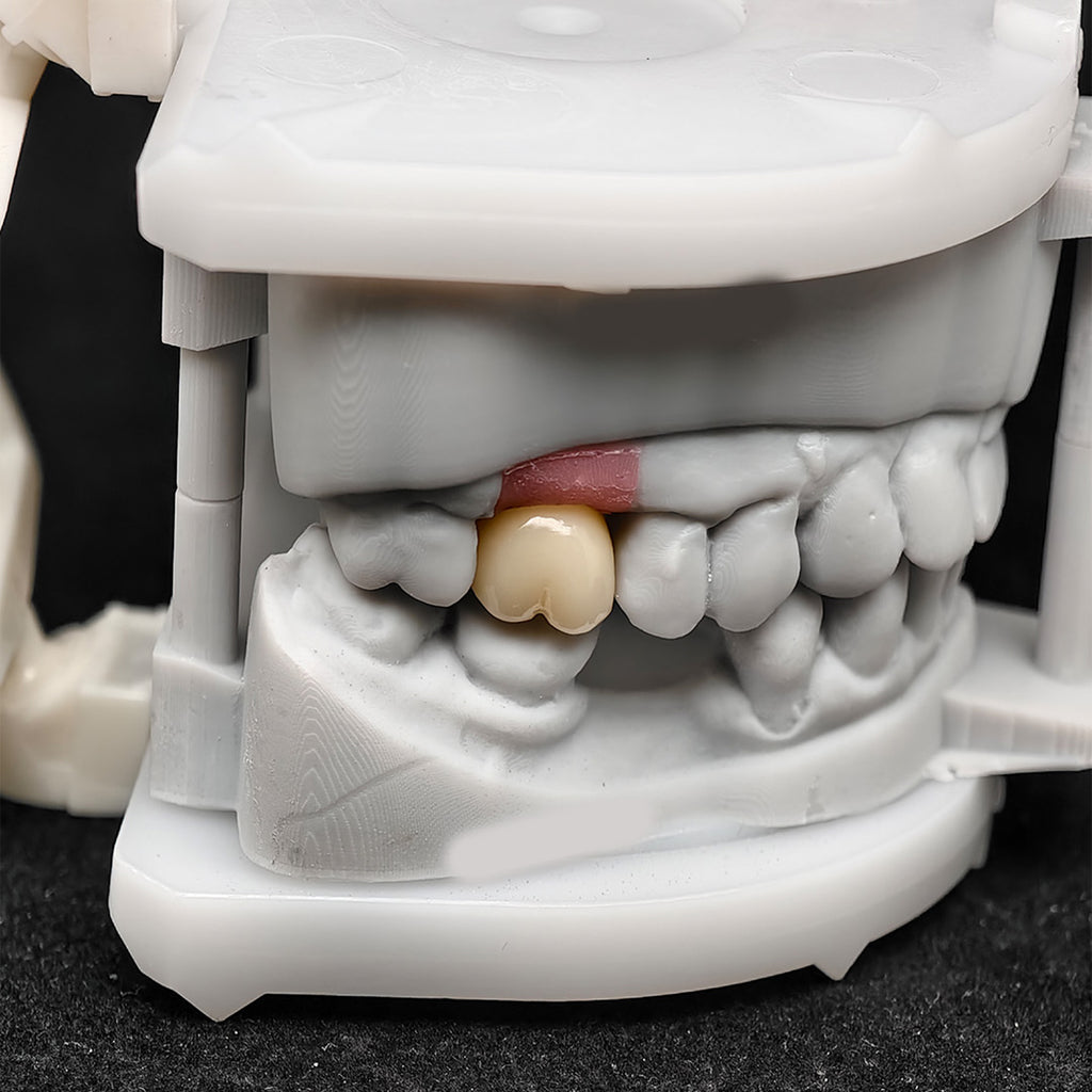 Custom Zirconia Implant Crown