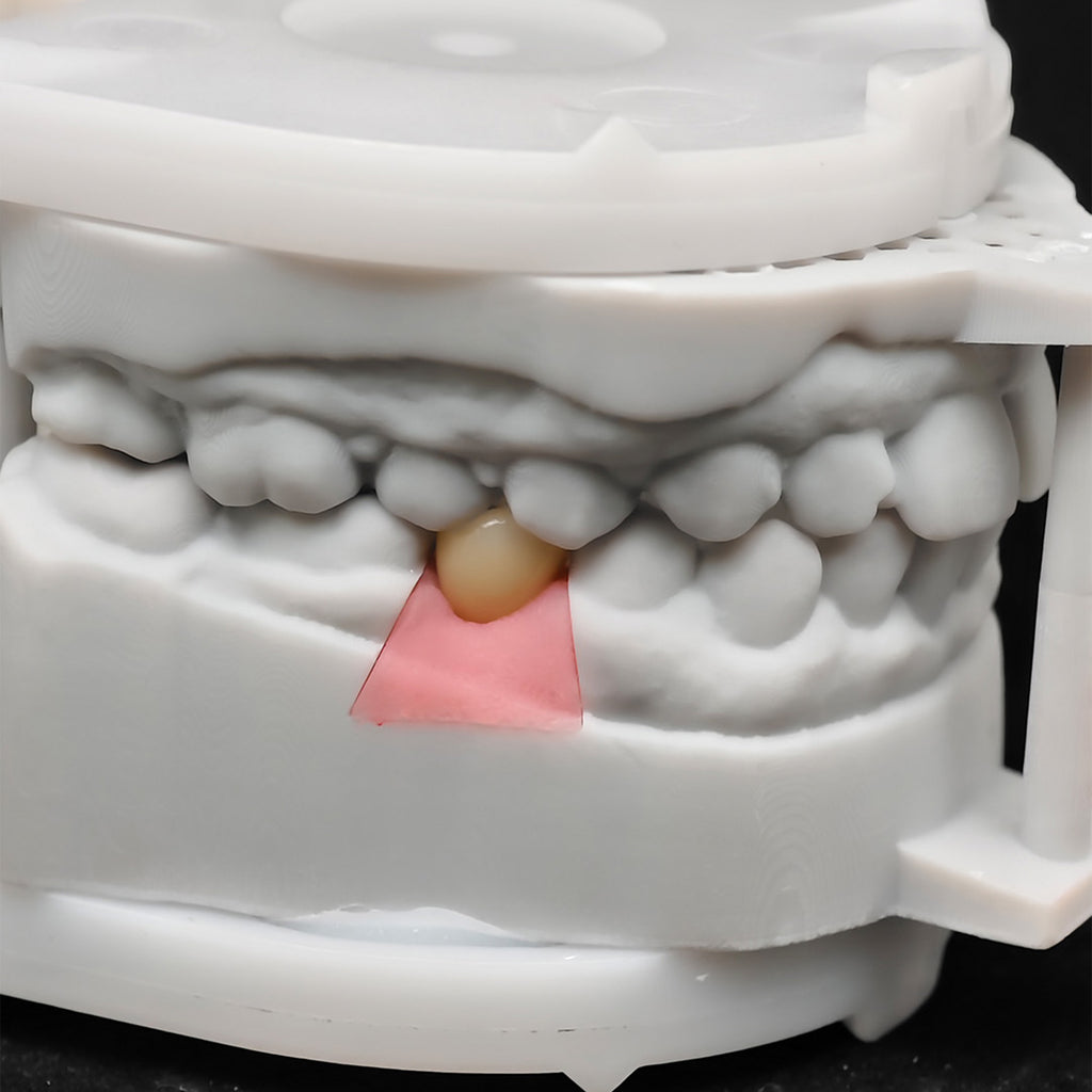 Custom Zirconia Implant Crown