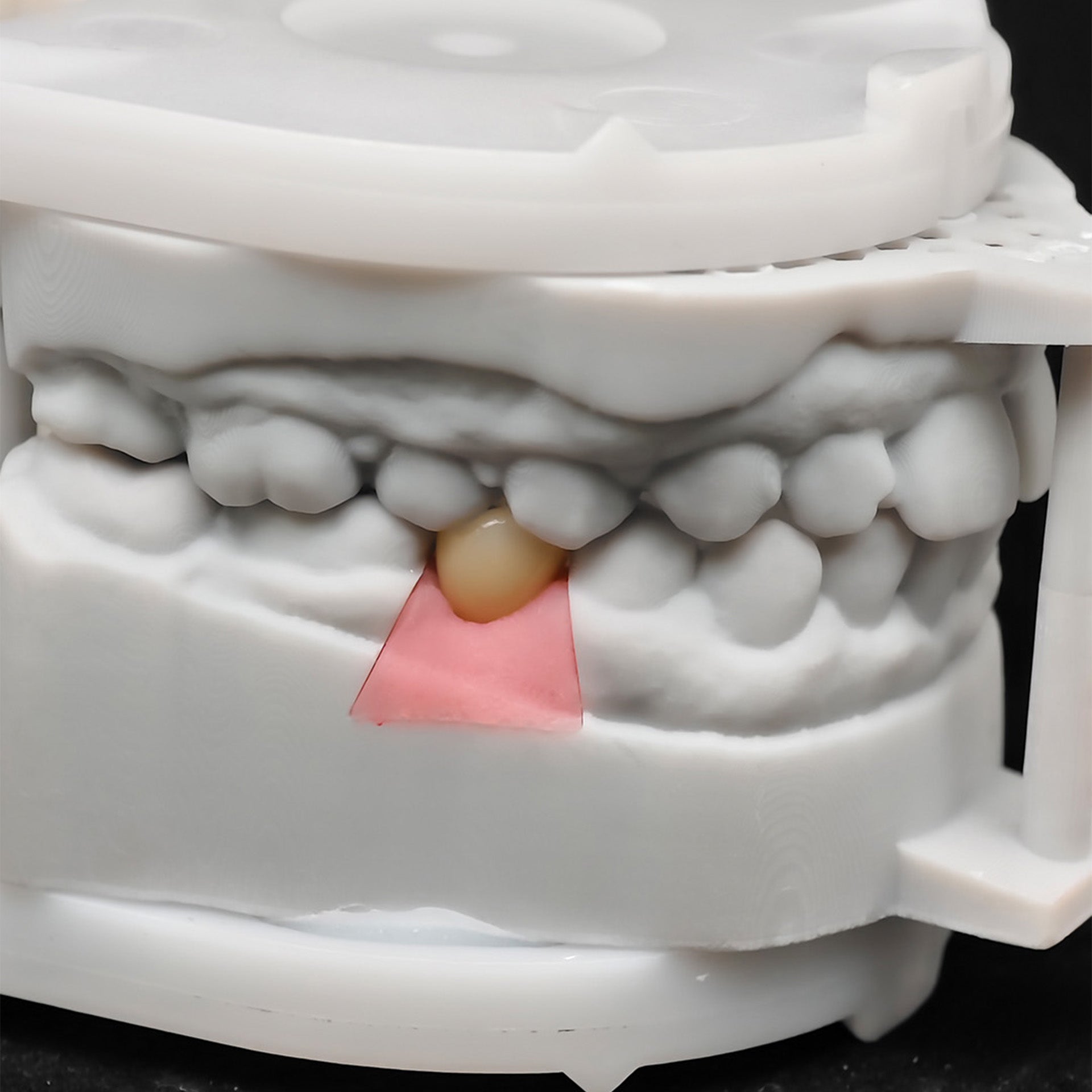 Custom Zirconia Implant Crown
