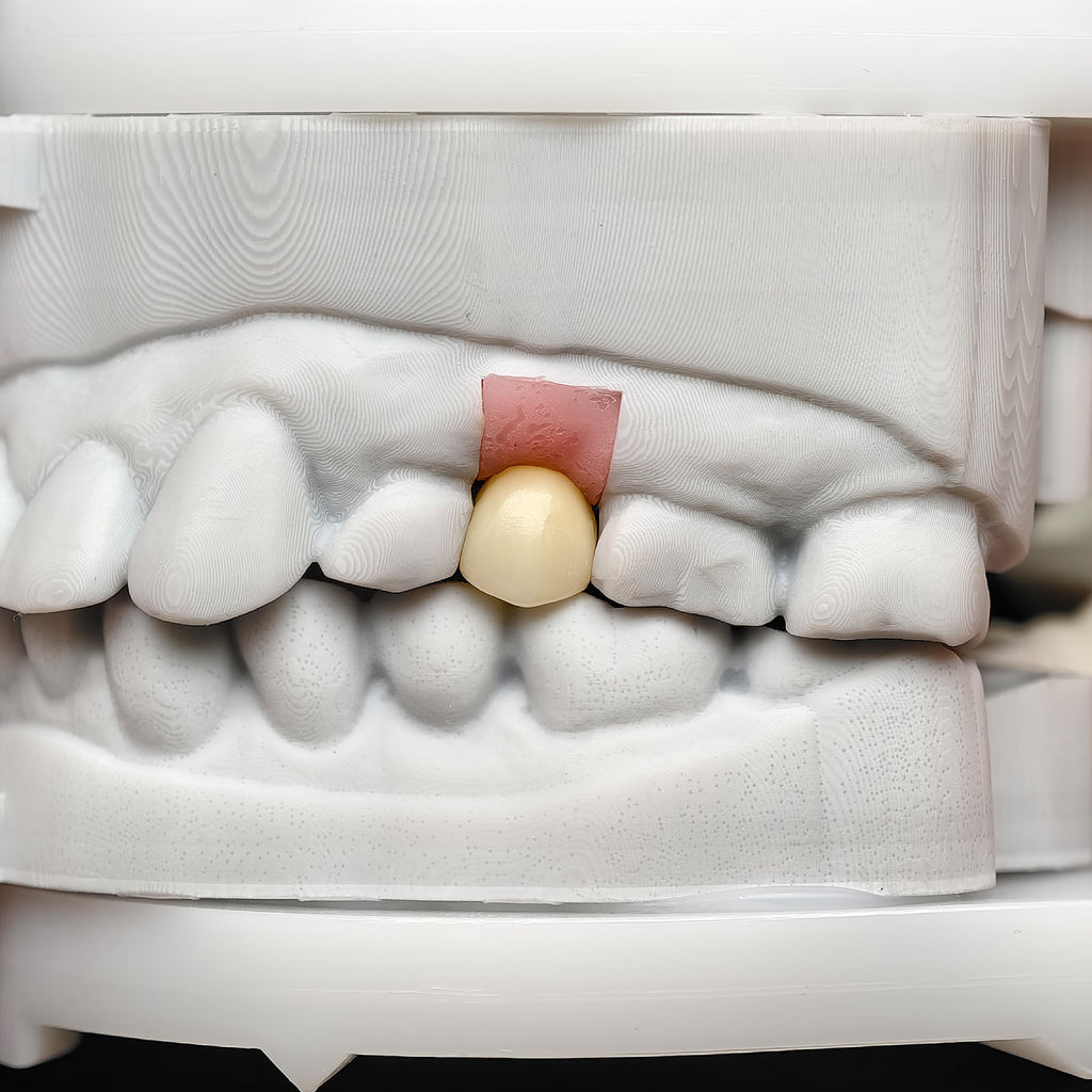 Custom Zirconia Implant Crowns