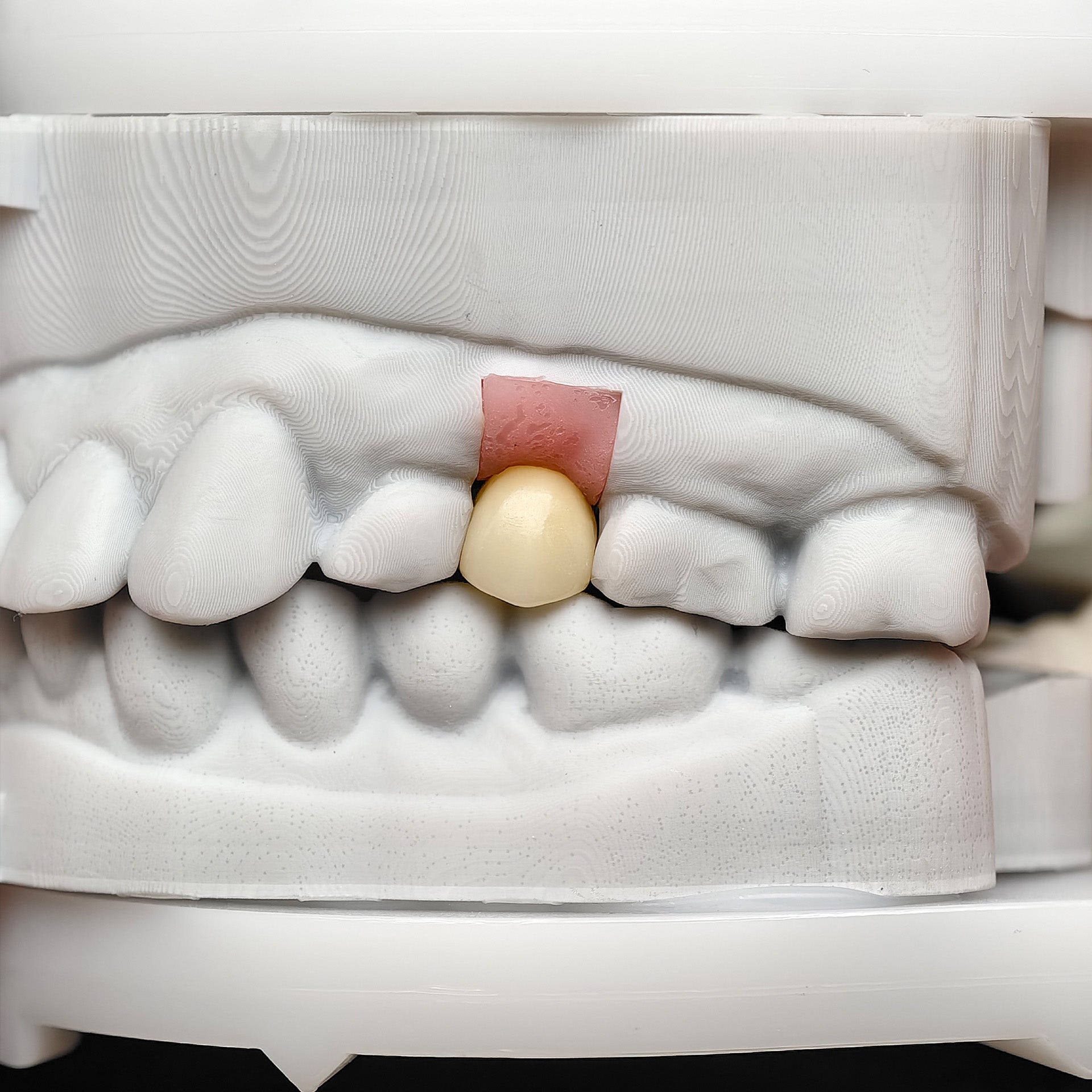Custom Zirconia Implant Crowns
