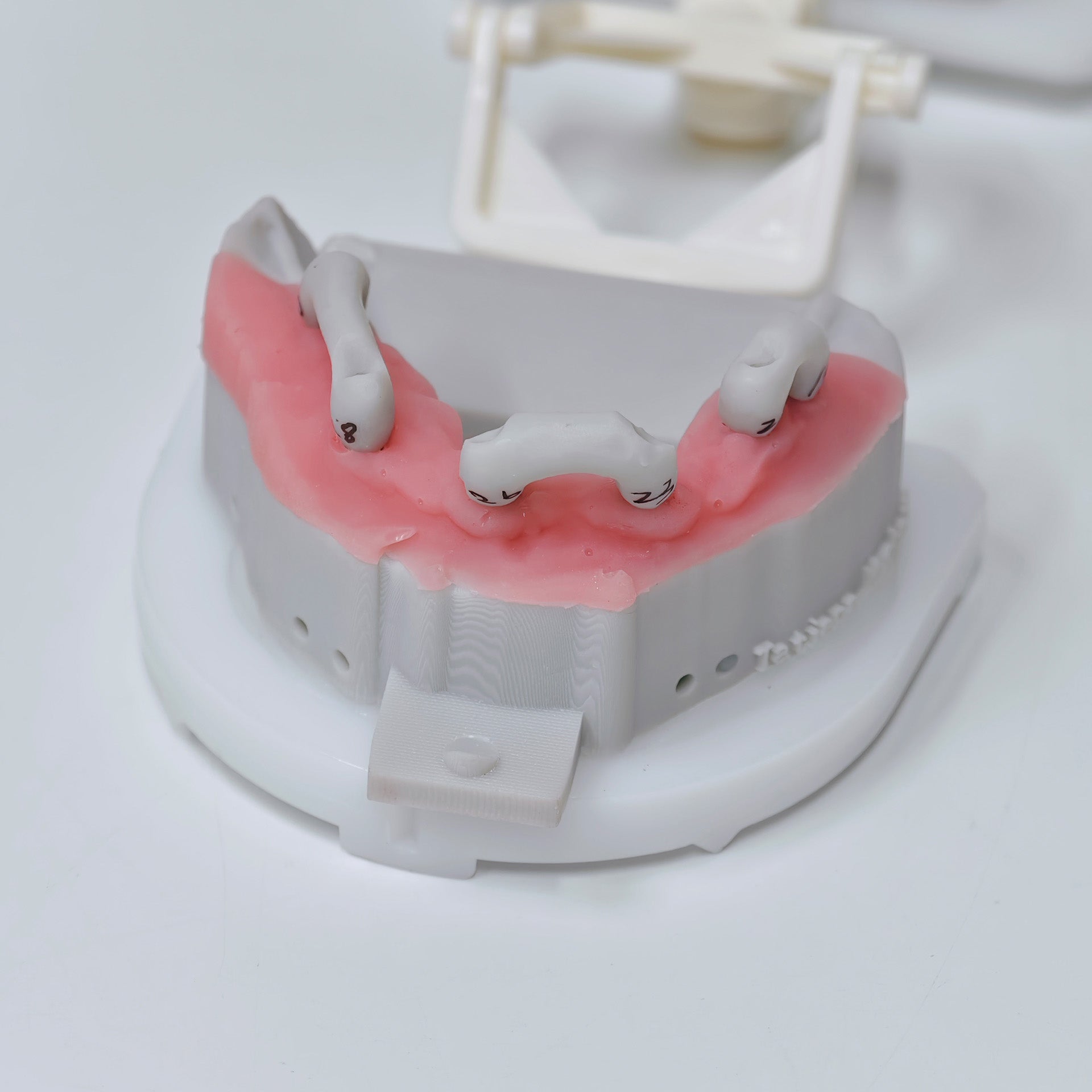 Custom Abutment And PMMA Bridge With Cement Retained And Implant Seating Guide