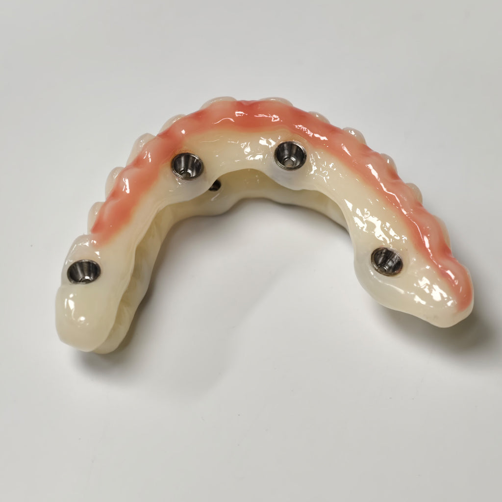 Full-Arch PMMA Bridge With Ti-Base Screw Retained