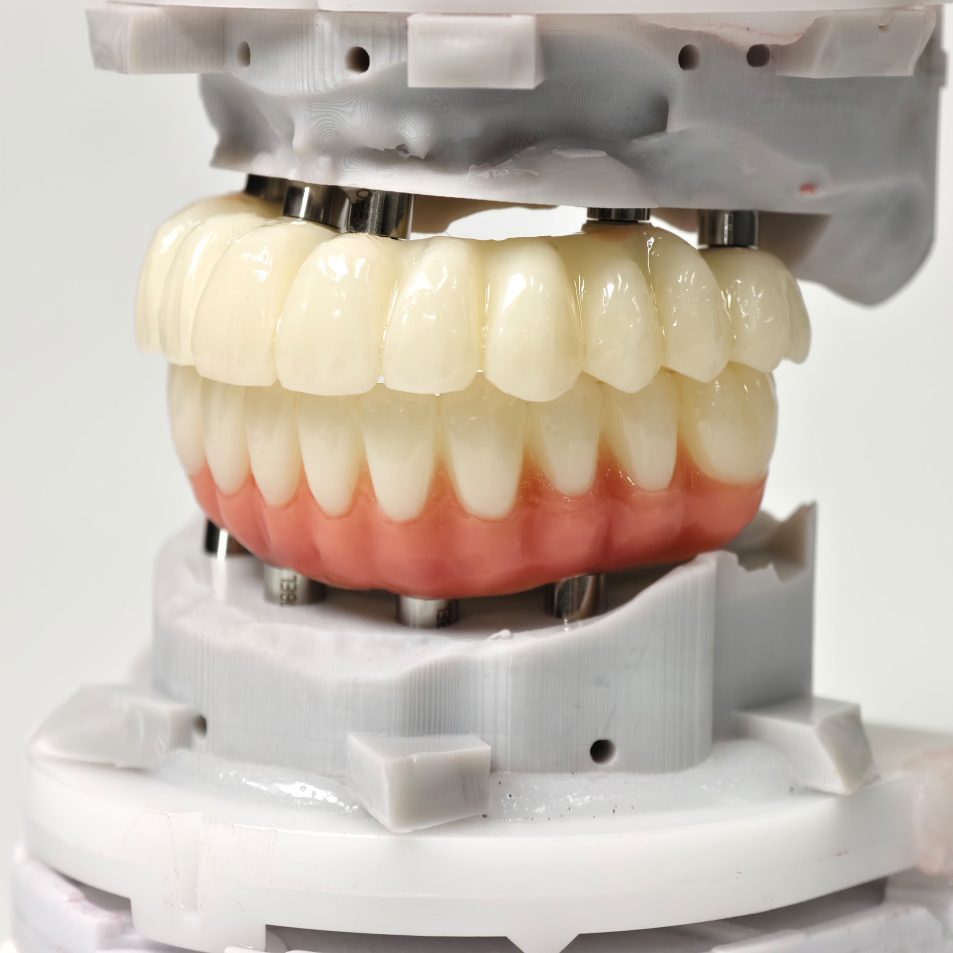 Full-Arch PMMA Bridge With Ti-Base Screw Retained