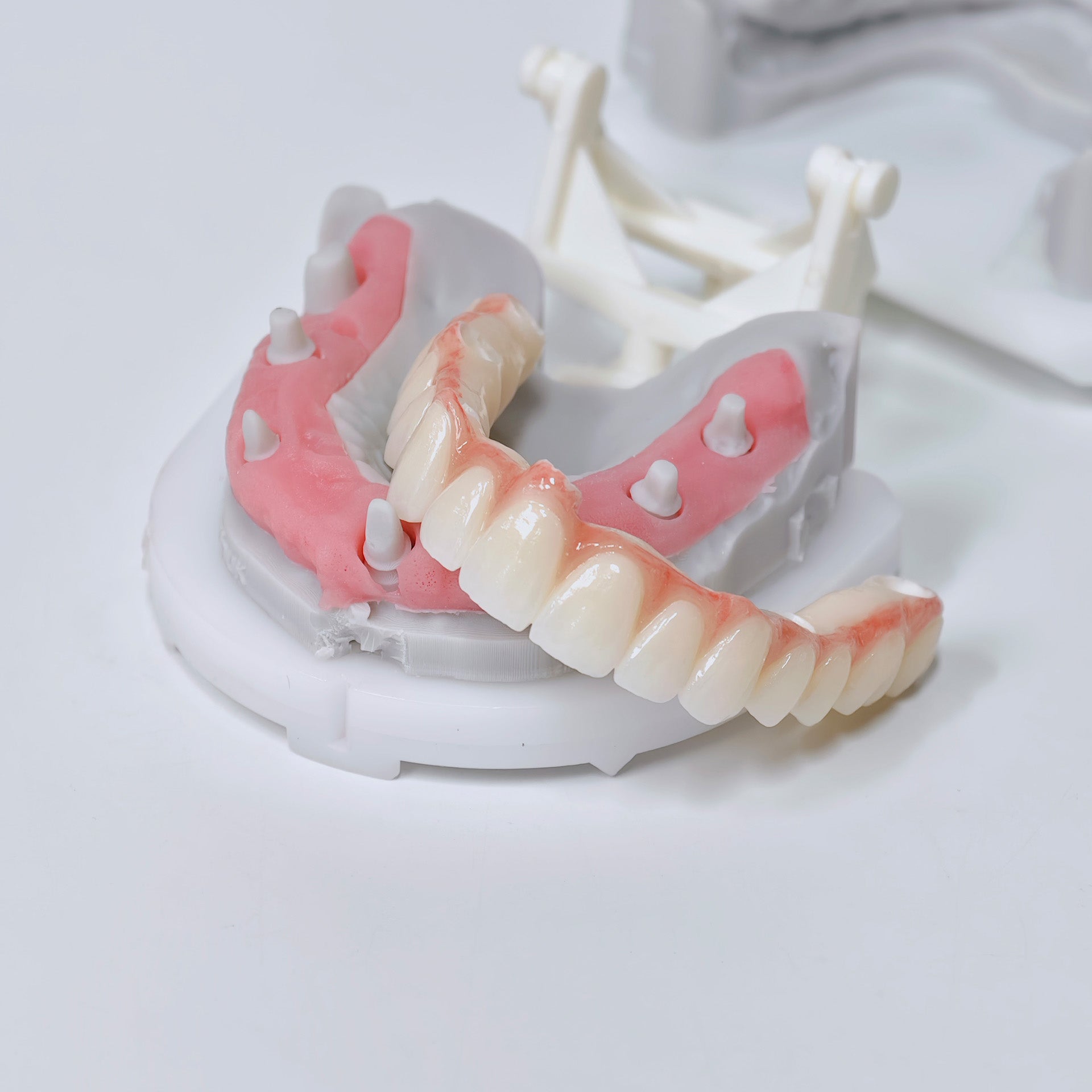 Half-Mouth Zirconia Bridge With Cement-Retained