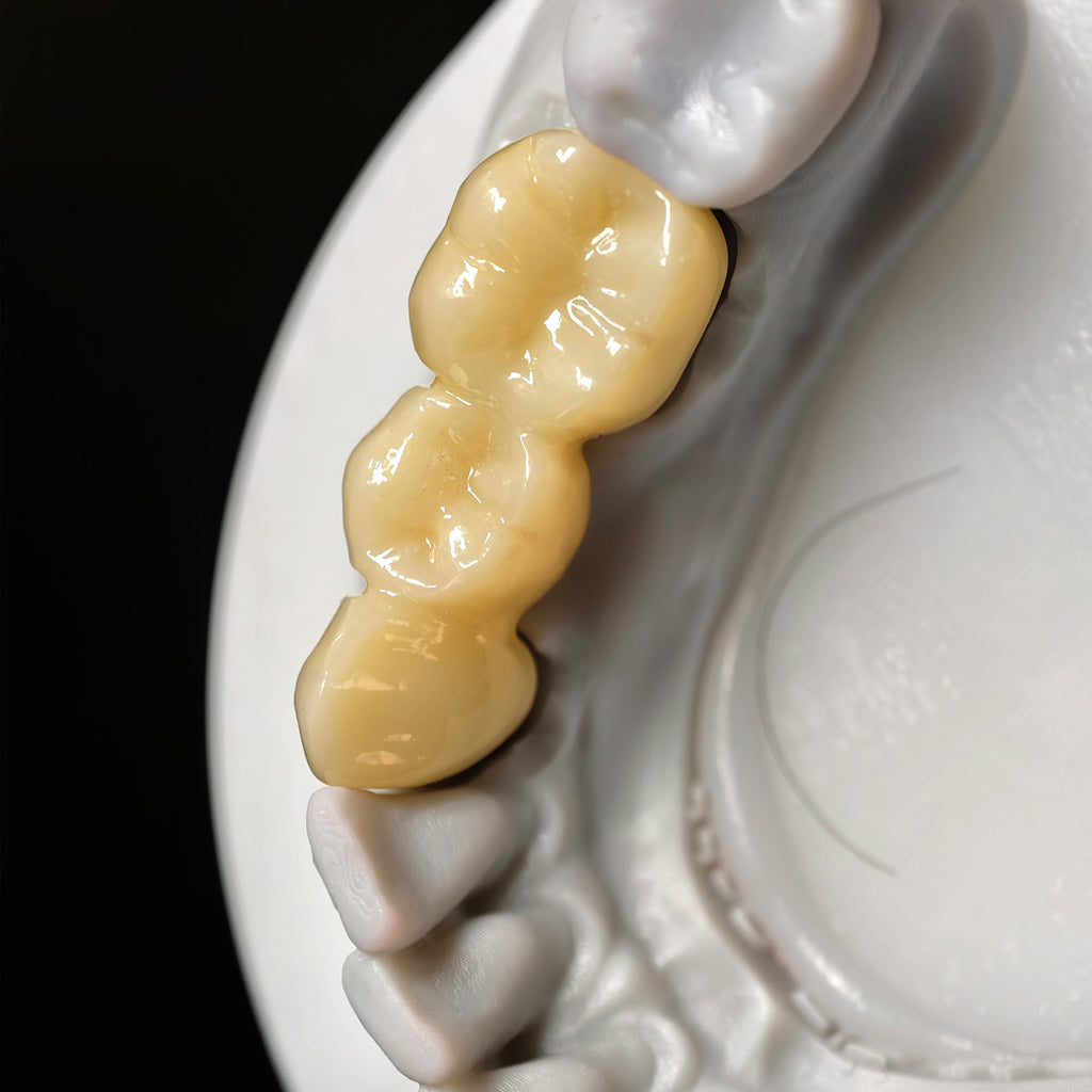 High - Strength Zirconia Bridge