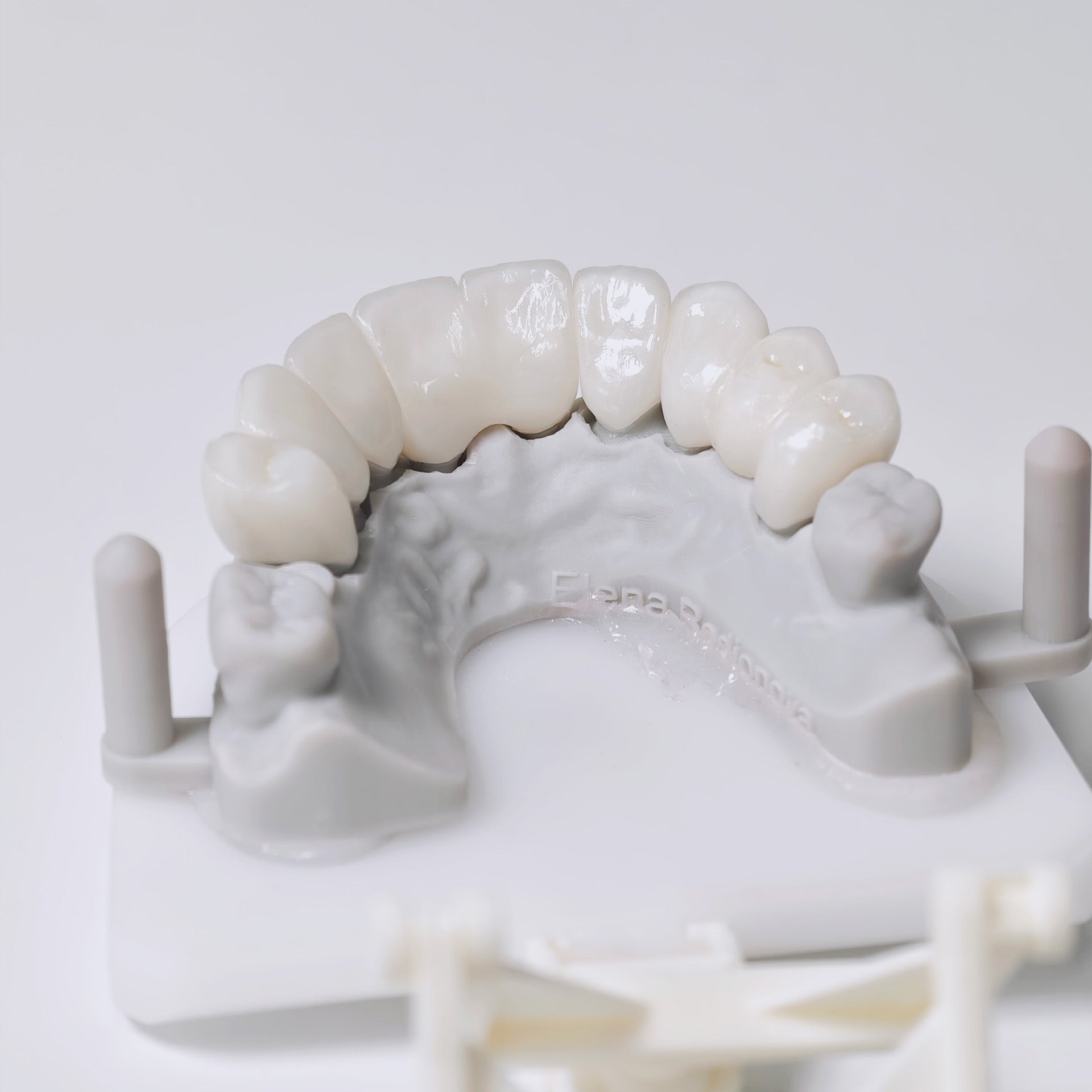 High - Strength Zirconia Bridge Aesthetic