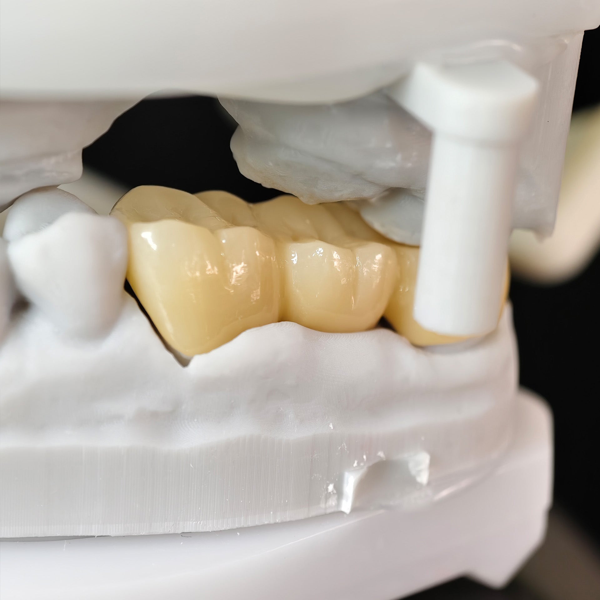 High - Strength Zirconia Bridge