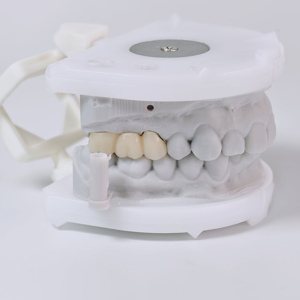High - Strength Zirconia Bridge