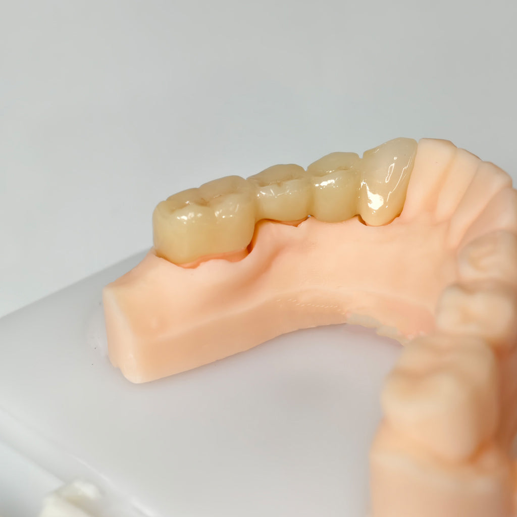 High - Strength Zirconia Bridge