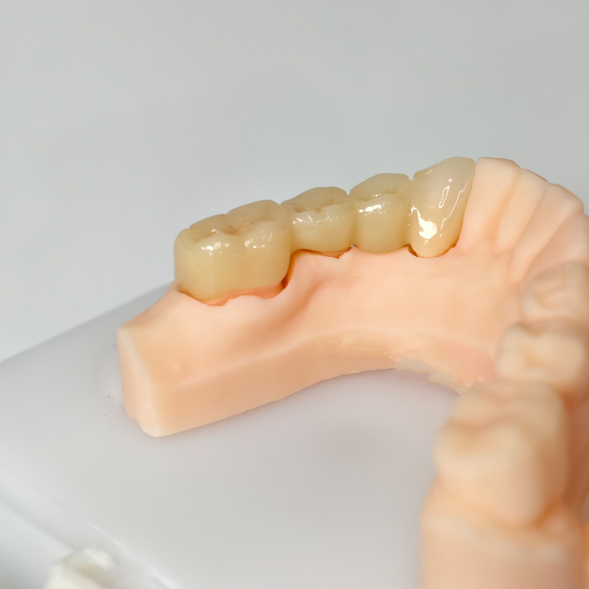 High - Strength Zirconia Bridge
