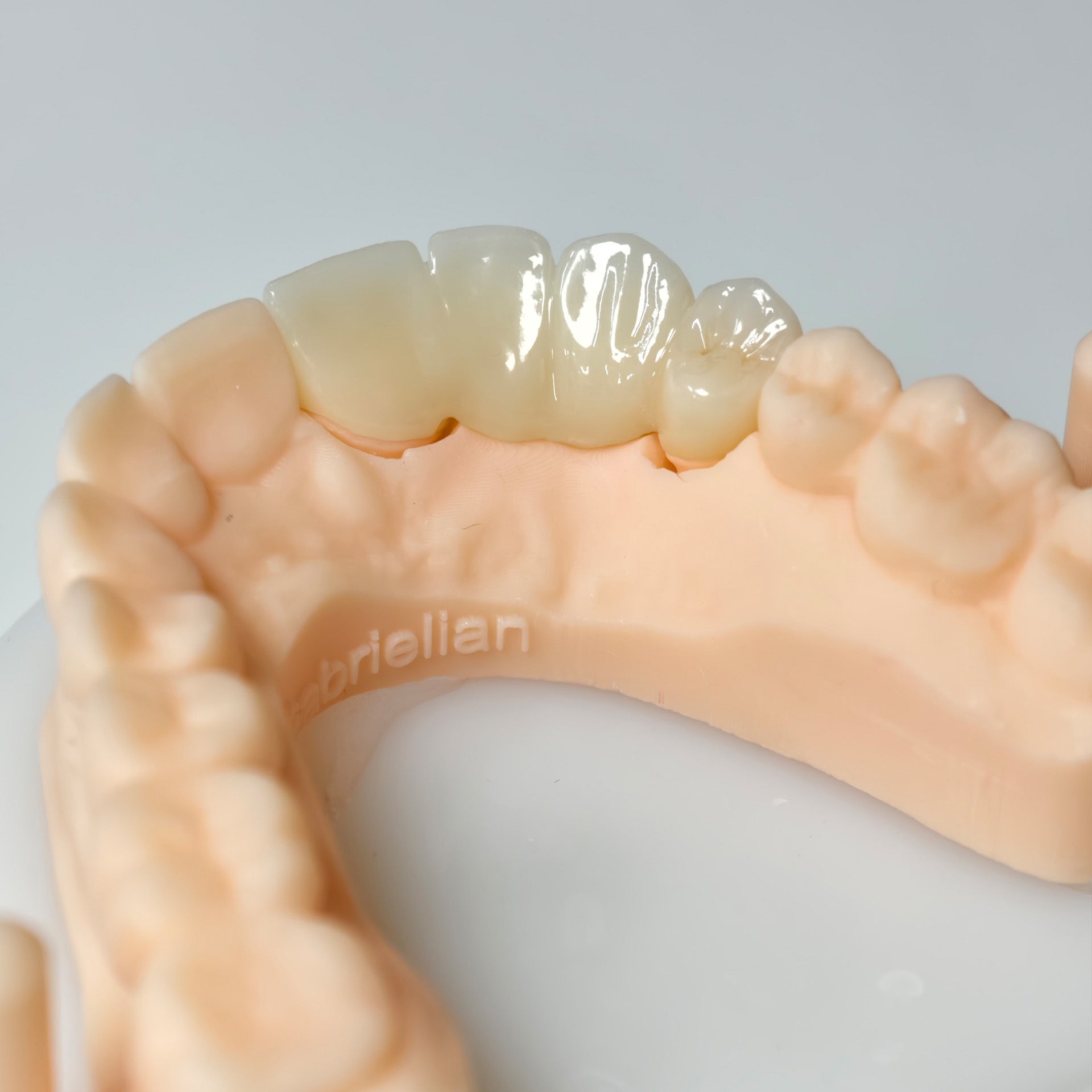 High - Strength Zirconia Bridge
