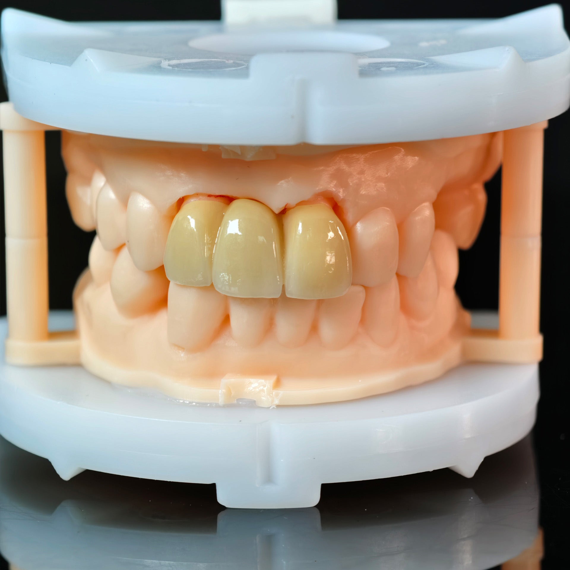 High - Strength Zirconia Bridge