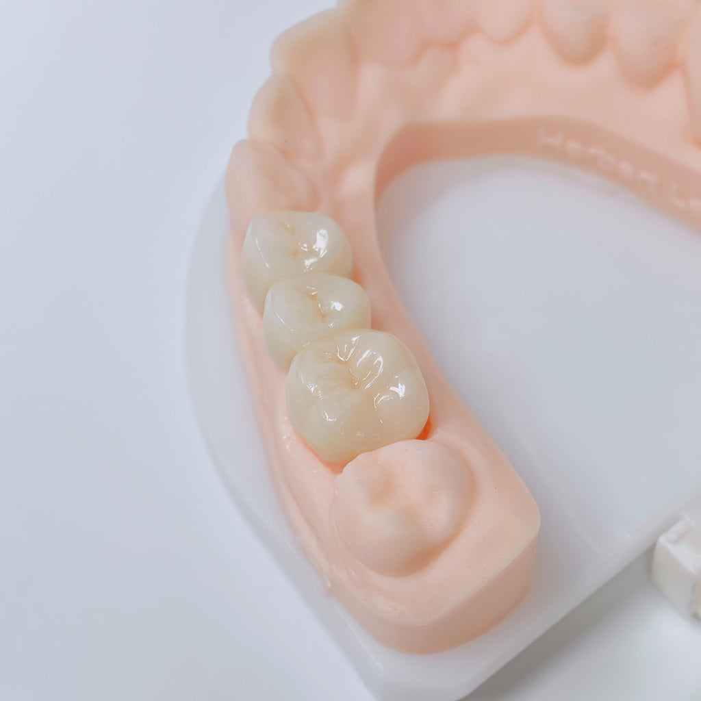 High - Strength Zirconia Bridge