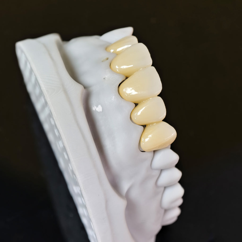 High - Strength Zirconia Bridge