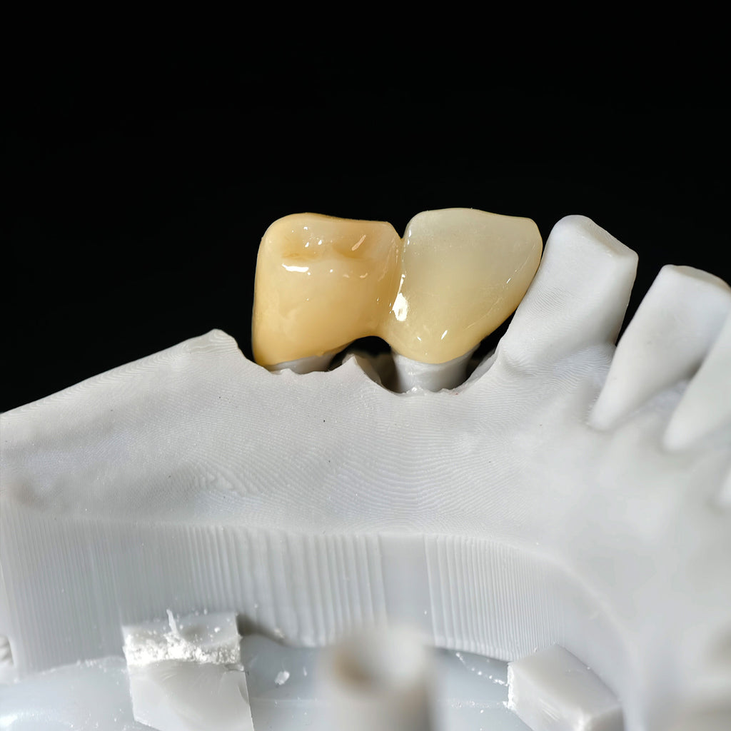 High - Strength Zirconia Bridge