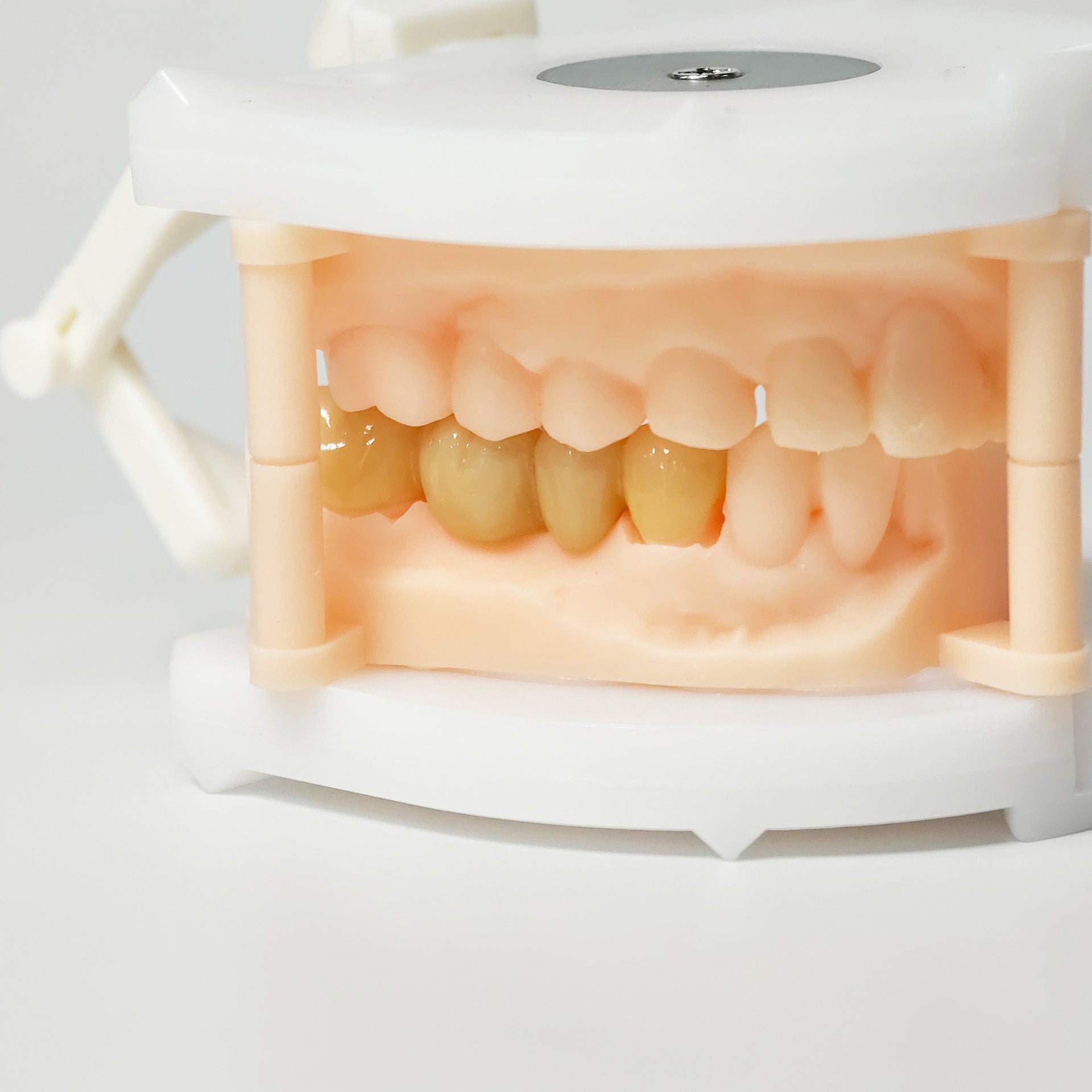 High - Strength Zirconia Bridge