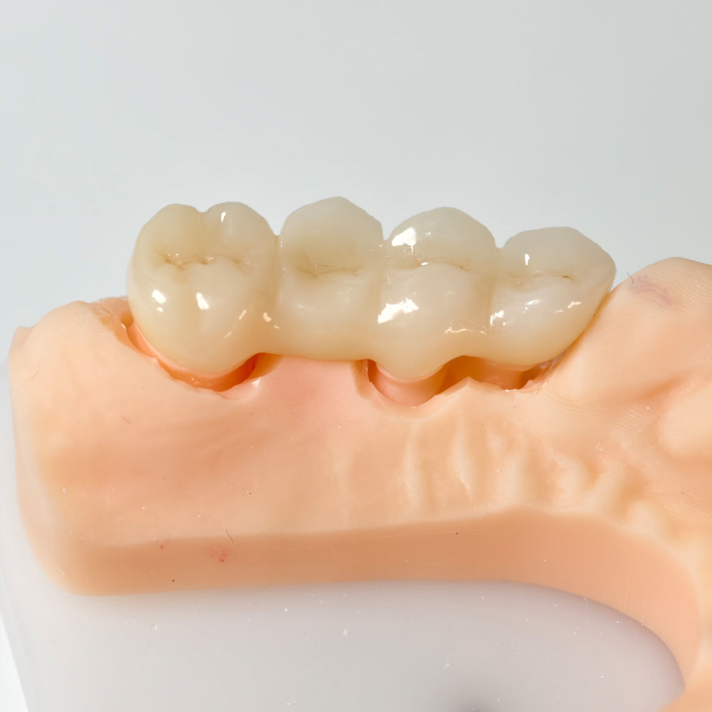 High - Strength Zirconia Bridge