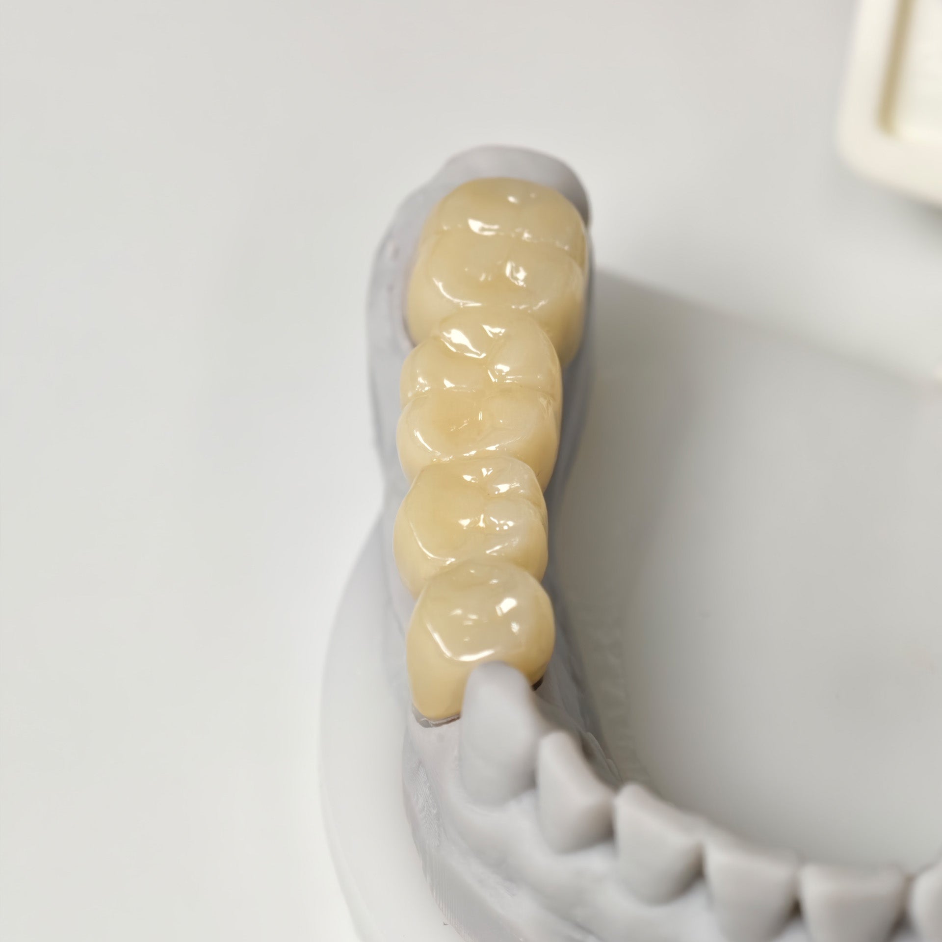 High - Strength Zirconia Bridge