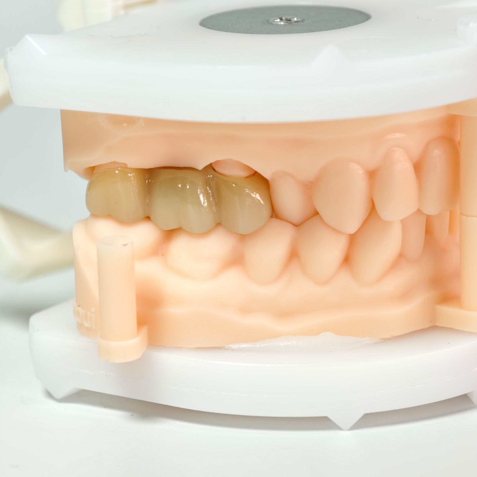High - Strength Zirconia Bridge