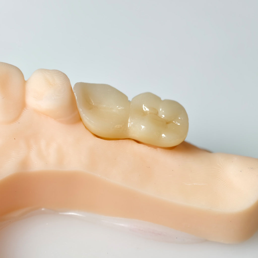 High - Strength Zirconia Bridge