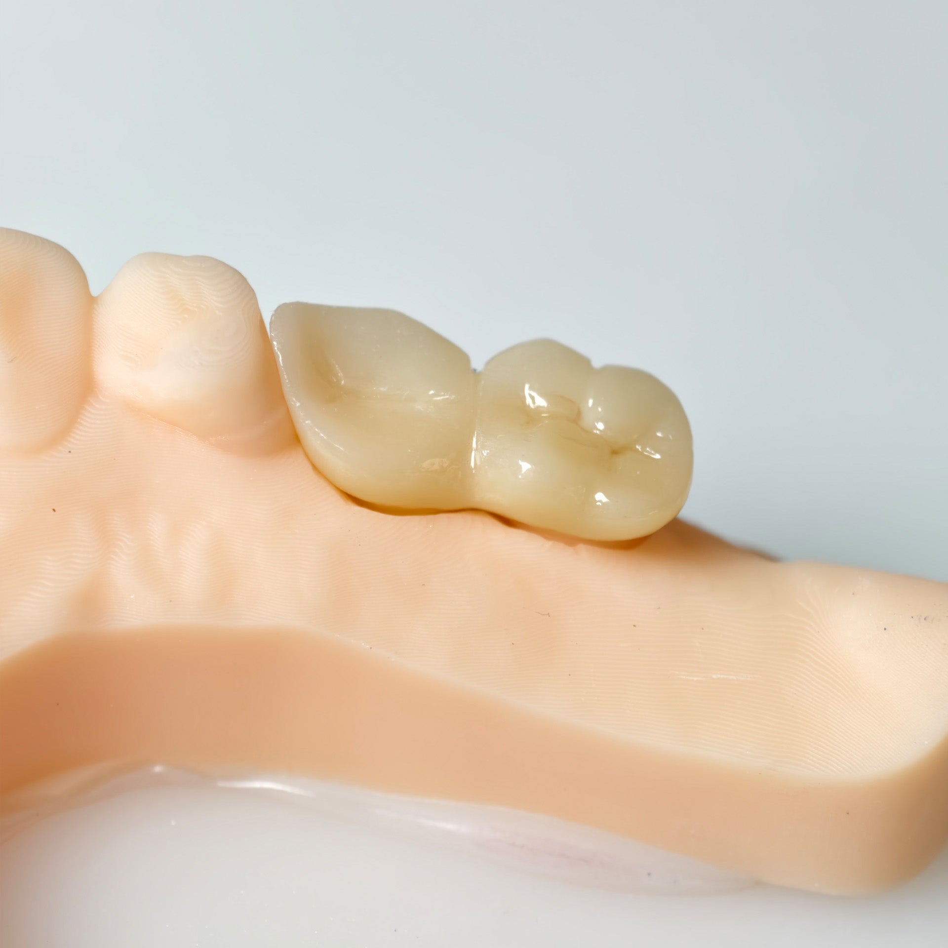 High - Strength Zirconia Bridge