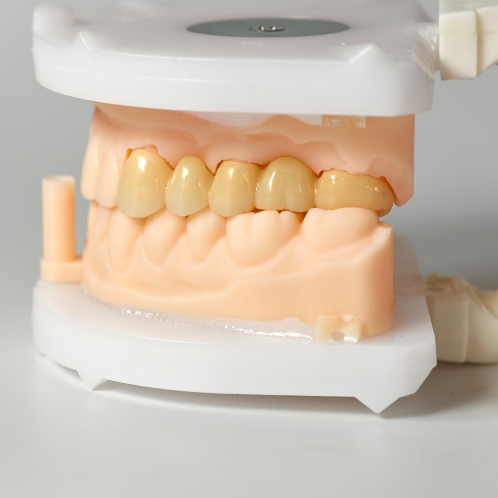 High - Strength Zirconia Bridge